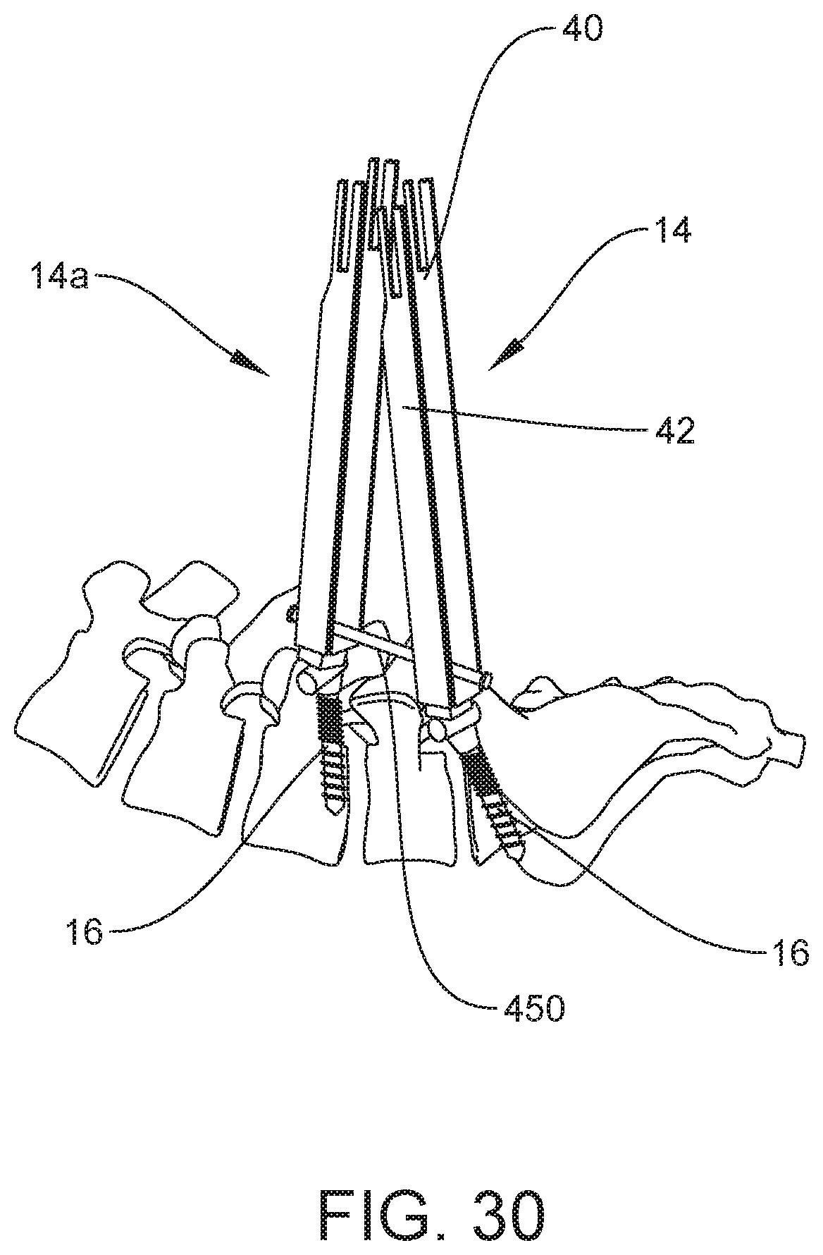 Patent US12303121 Figure 18 – Surgical system and method