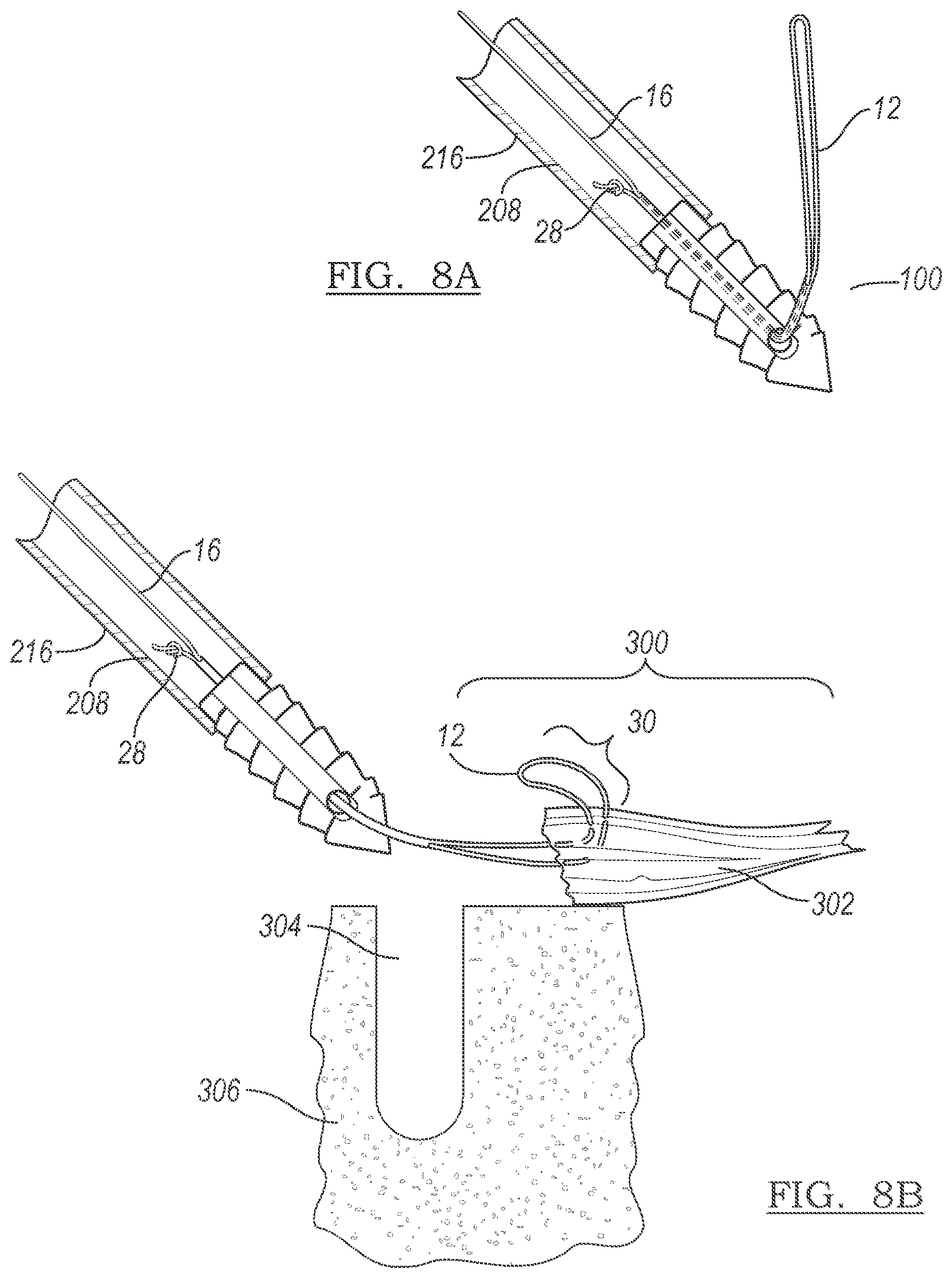 Patent US12303122 Figure 4 – Adjustable knotless loops