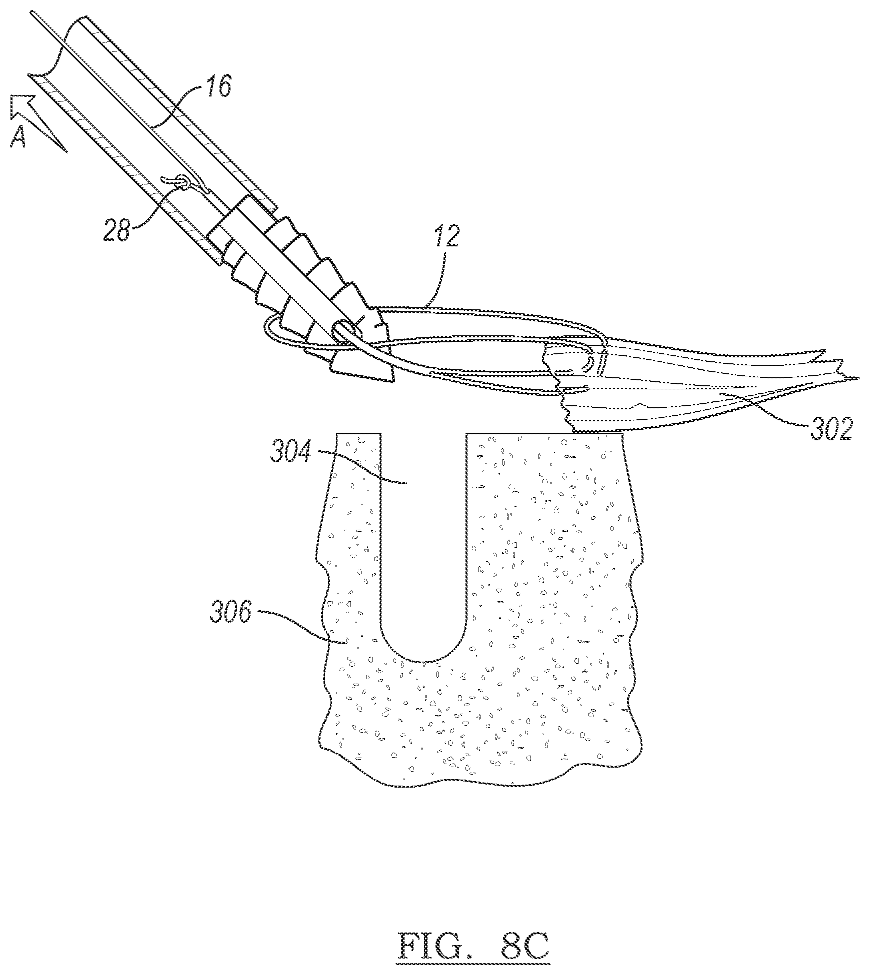 Patent US12303122 Figure 5 – Adjustable knotless loops