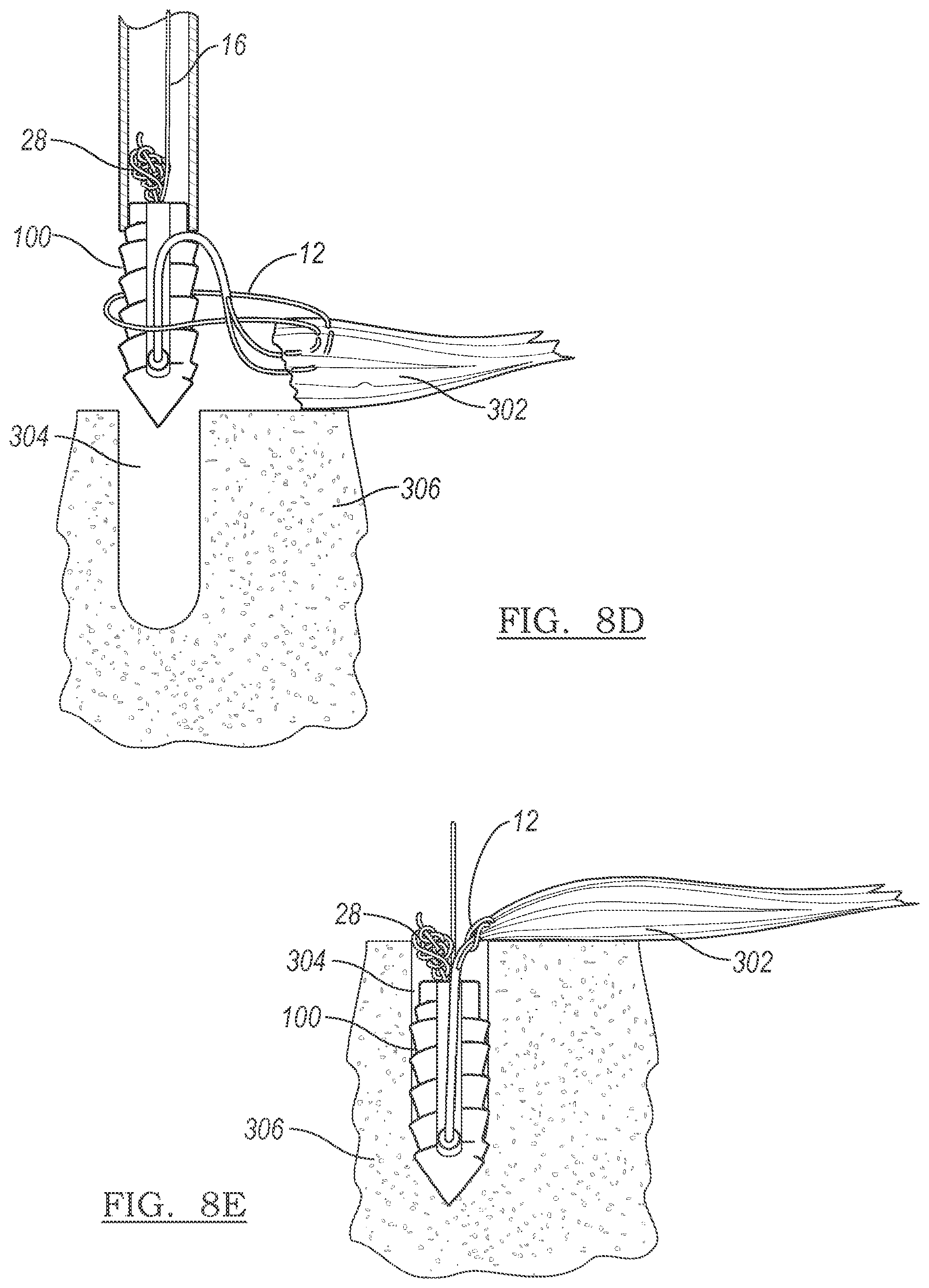 Patent US12303122 Figure 6 – Adjustable knotless loops