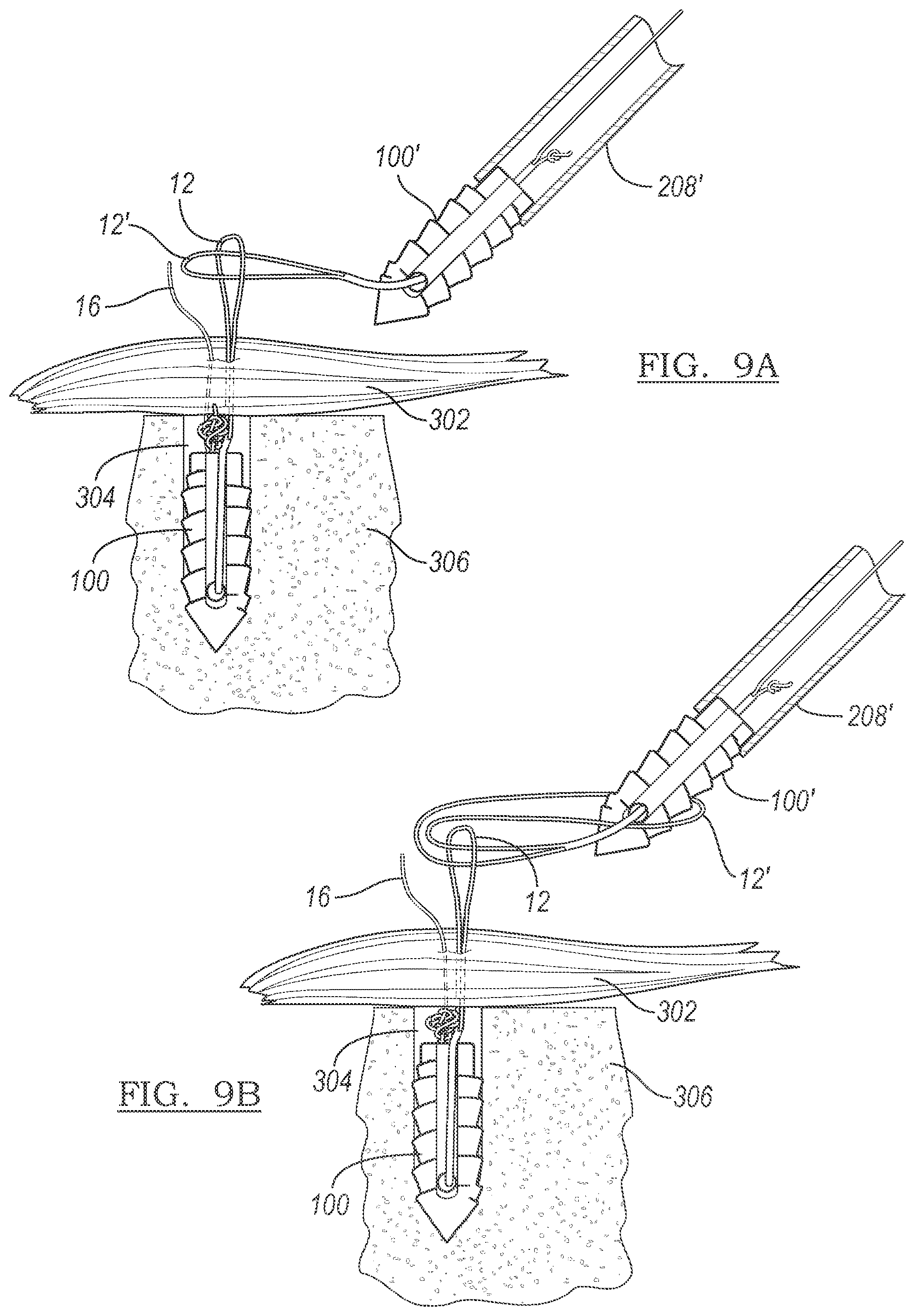 Patent US12303122 Figure 7 – Adjustable knotless loops
