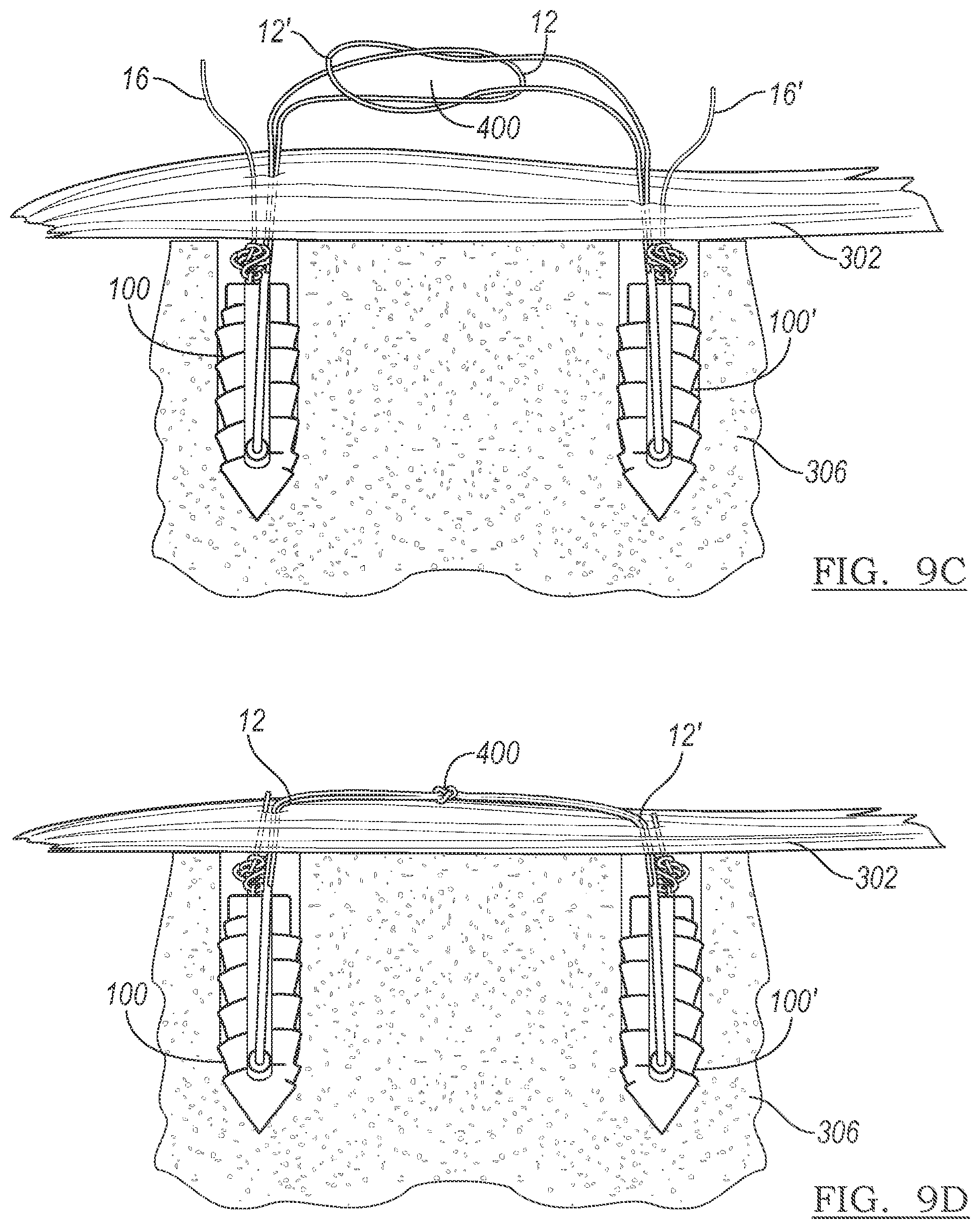 Patent US12303122 Figure 8 – Adjustable knotless loops