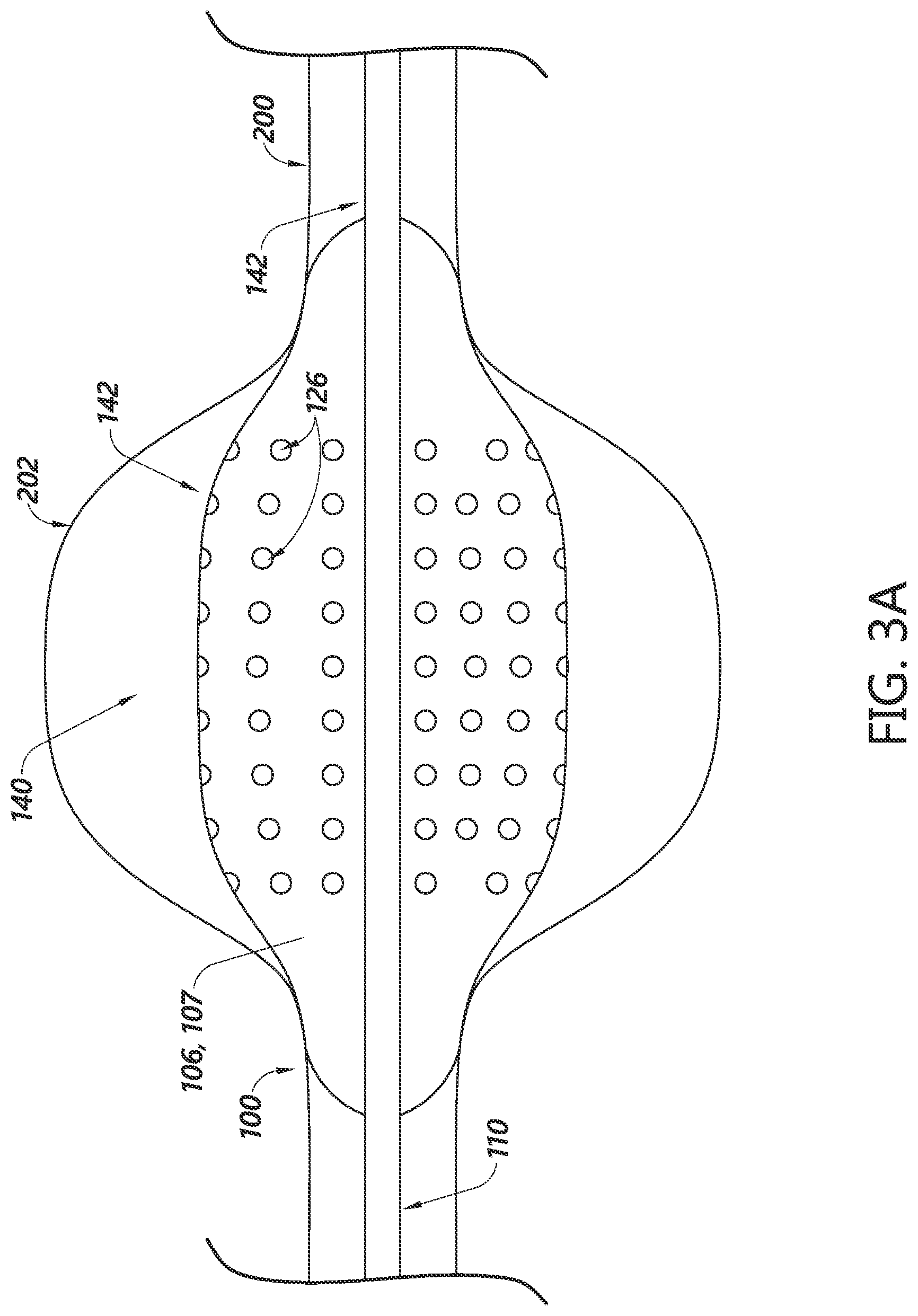 Patent US12303134 Figure 5 – Systems for aneurysm treatment