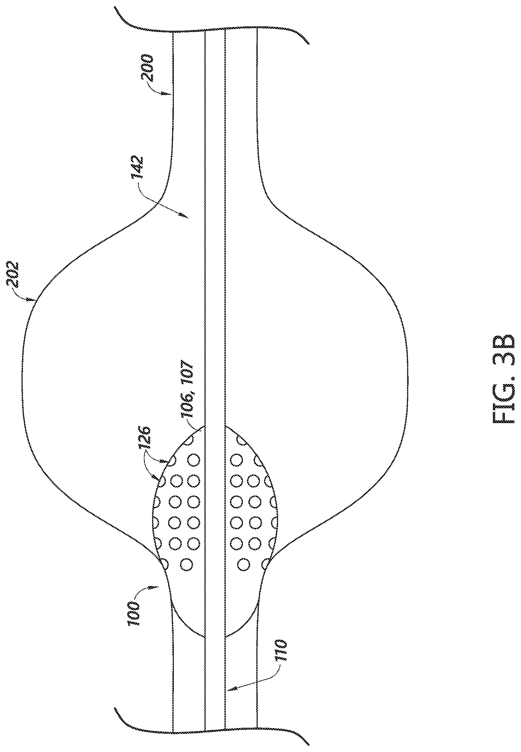 Patent US12303134 Figure 6 – Systems for aneurysm treatment