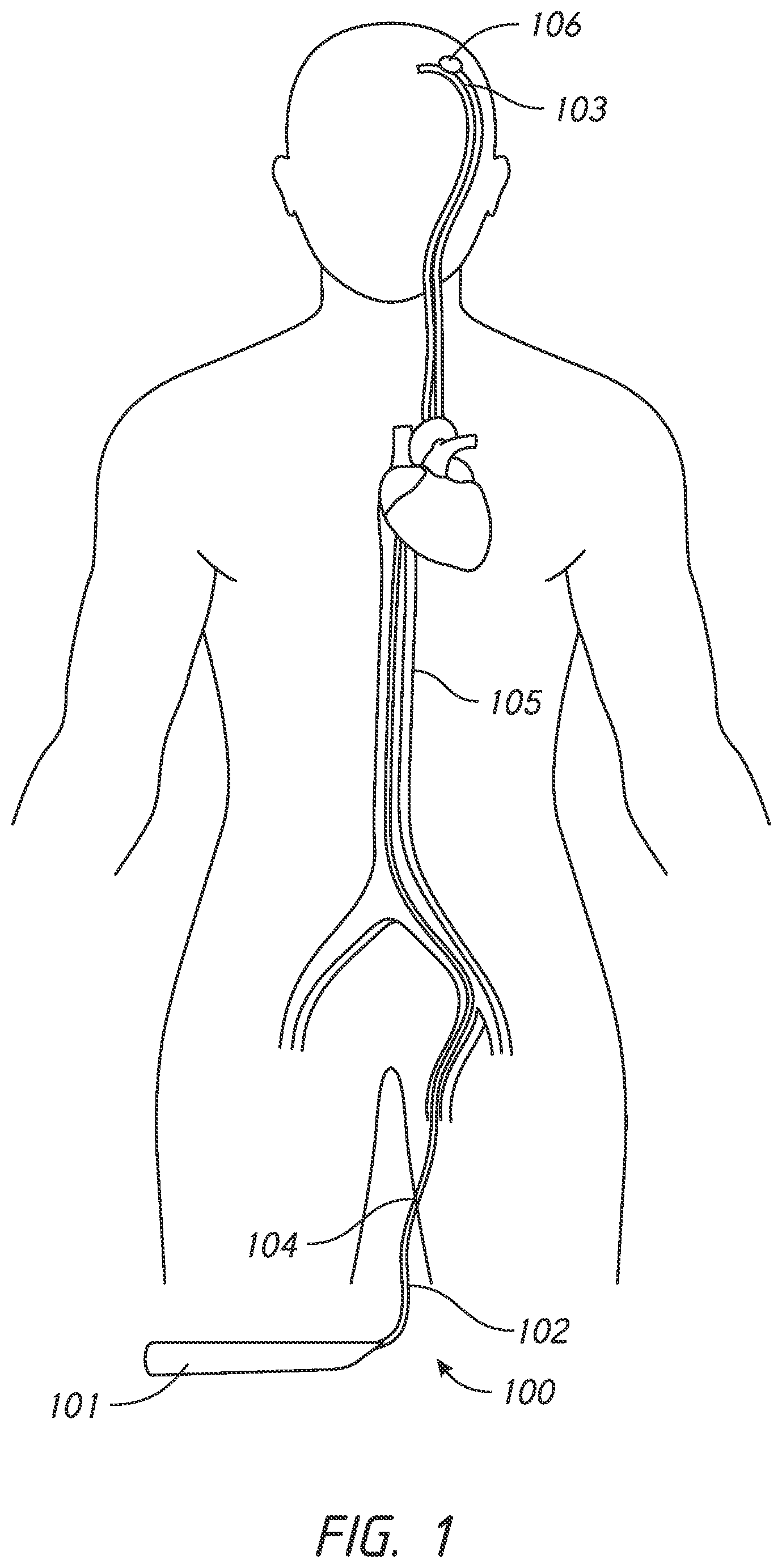 Patent US12303136 — System and methods for embolized occlusion of neurovascular aneurysms — Figure 1