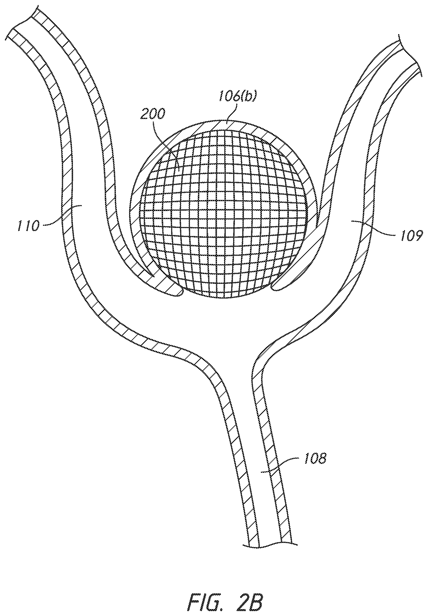 Patent US12303136 Figure 3 – System and methods for embolized occlusion of neurovascular aneurysms