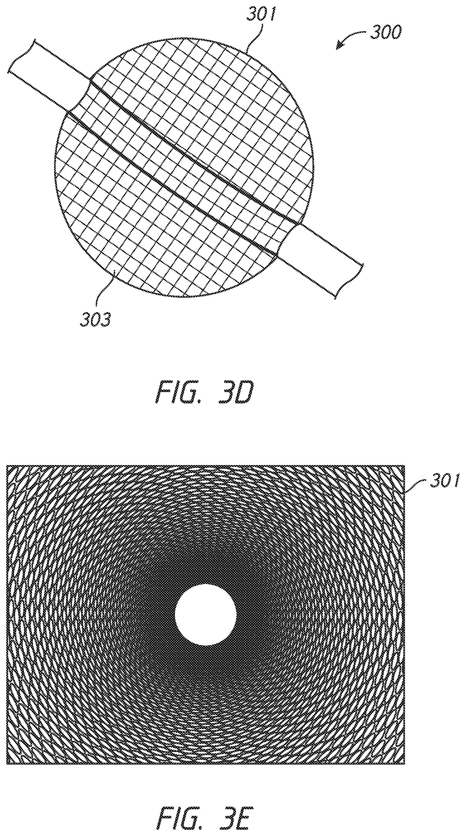 Patent US12303136 Figure 5 – System and methods for embolized occlusion of neurovascular aneurysms