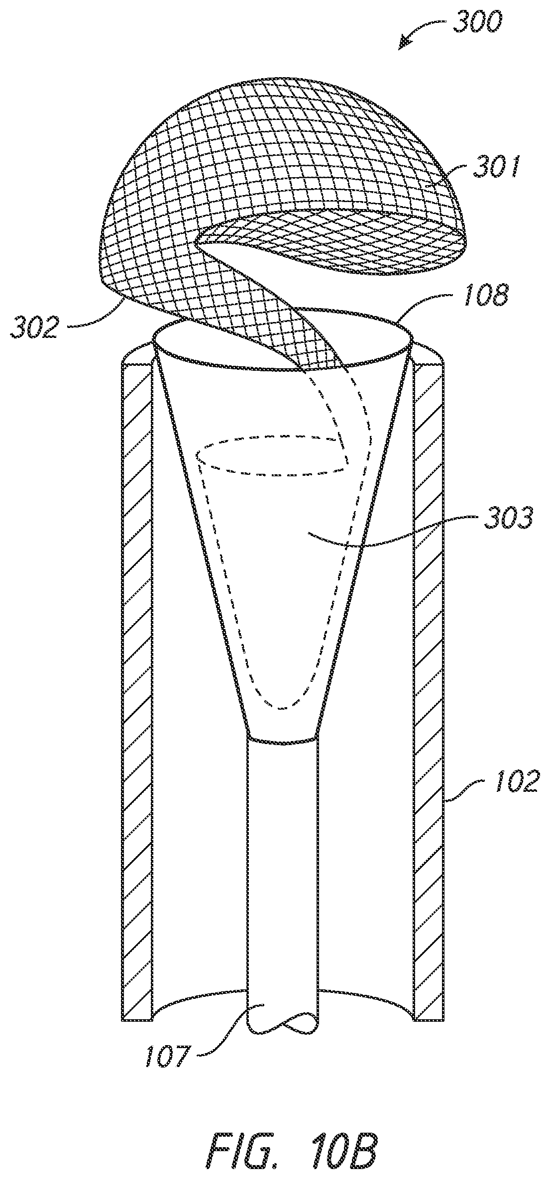 Patent US12303136 Figure 15 – System and methods for embolized occlusion of neurovascular aneurysms