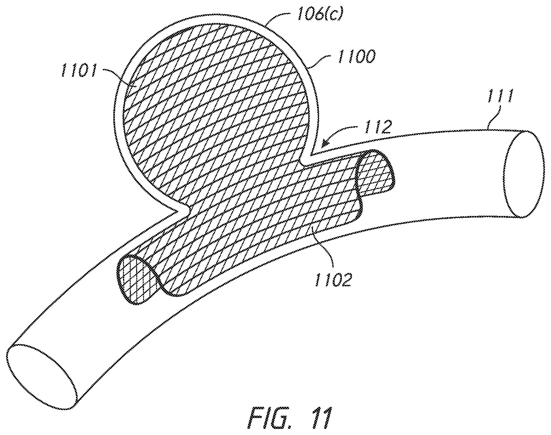 Patent US12303136 Figure 16 – System and methods for embolized occlusion of neurovascular aneurysms