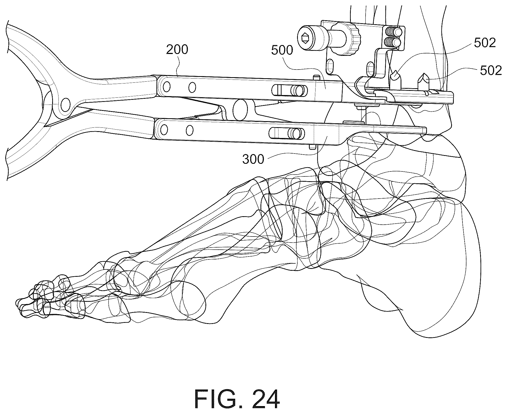 Patent US12303138 Figure 10 – Distractors having attachable paddles, impaction devices, and methods for use in total ankle replacement
