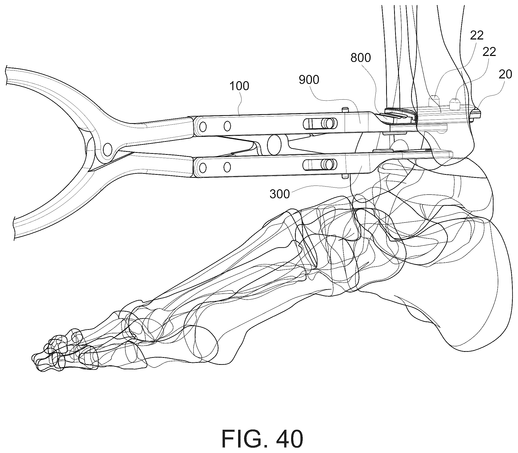 Patent US12303138 Figure 17 – Distractors having attachable paddles, impaction devices, and methods for use in total ankle replacement