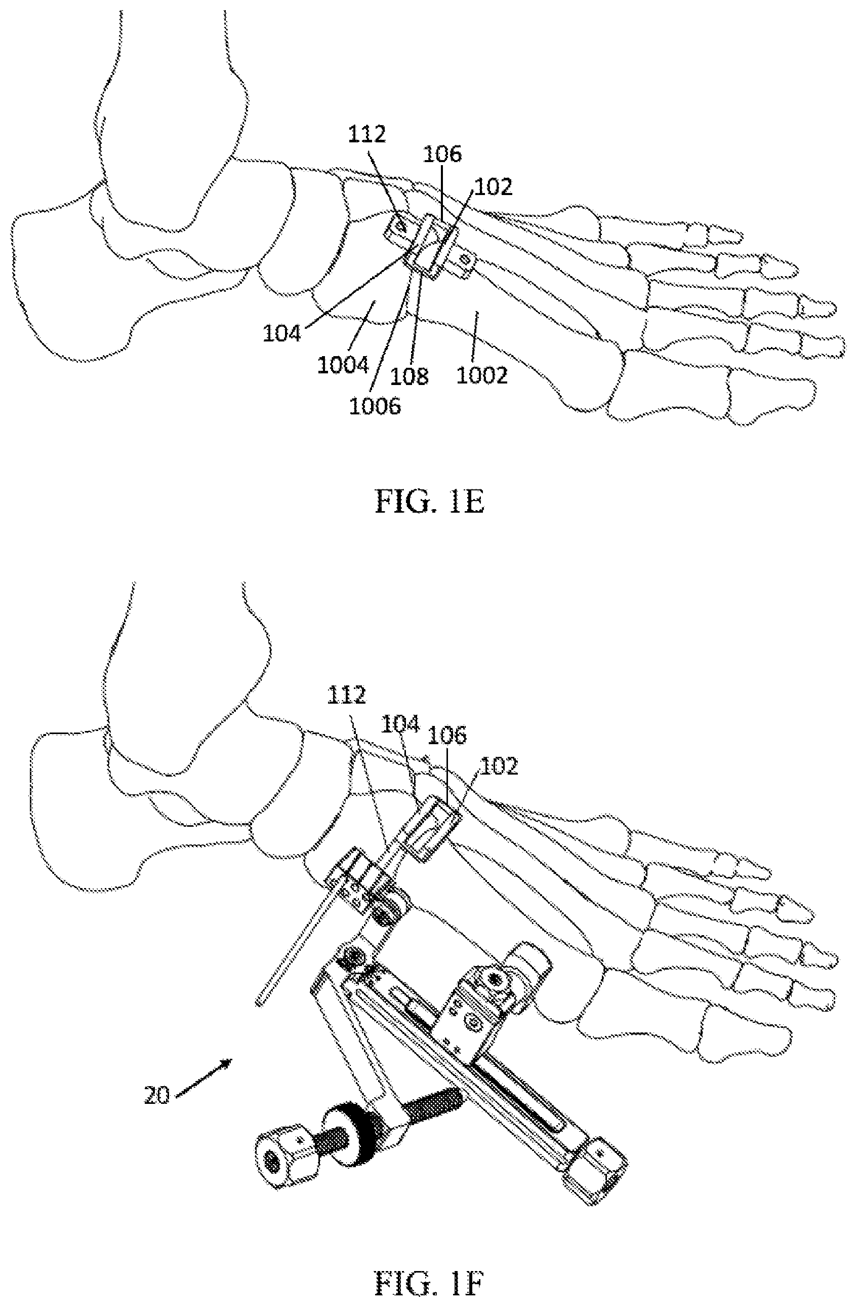 Patent US12303140 Figure 2 – Surgical systems and methods including cutting and aligning guides for performing an osteotomy
