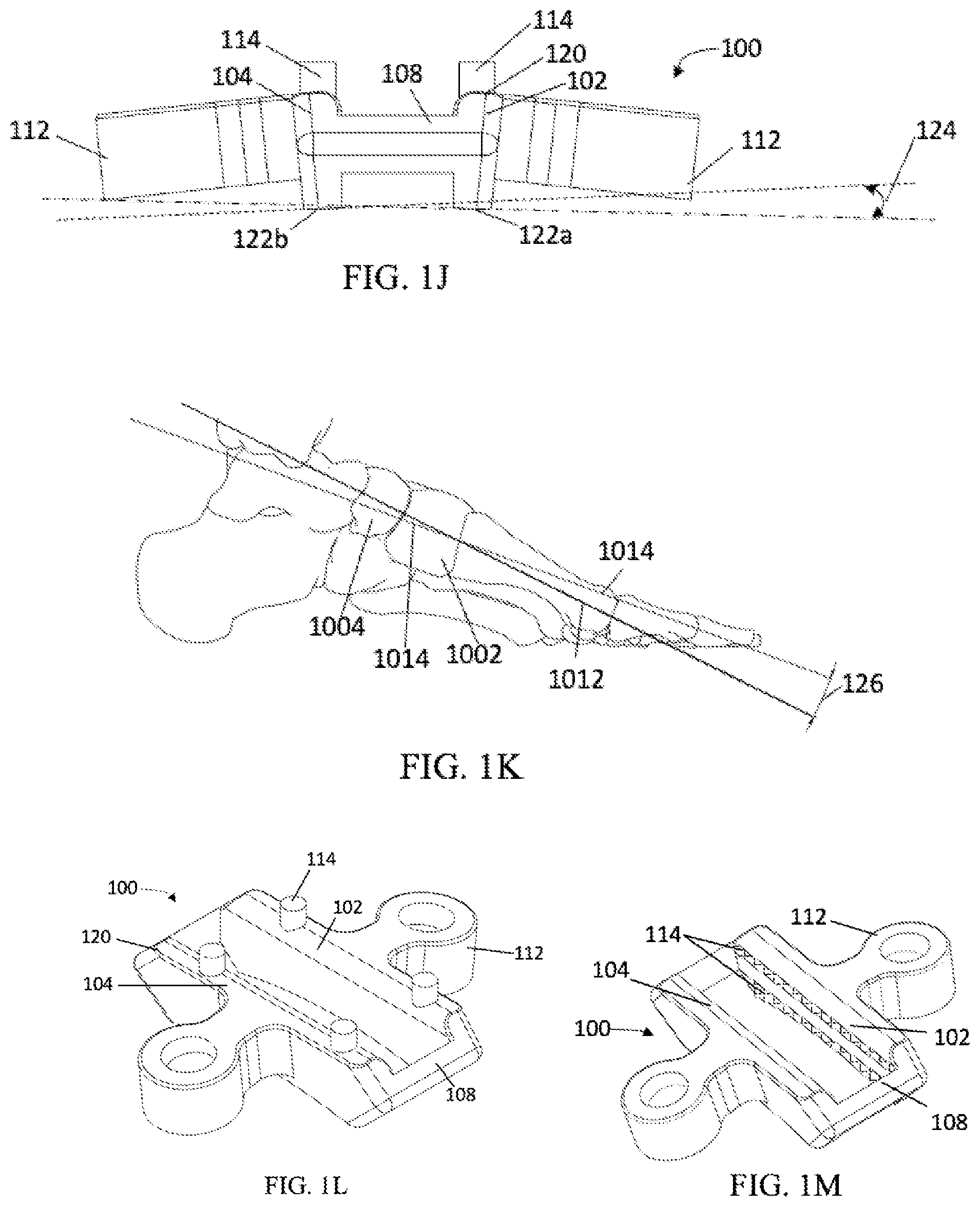 Patent US12303140 Figure 4 – Surgical systems and methods including cutting and aligning guides for performing an osteotomy