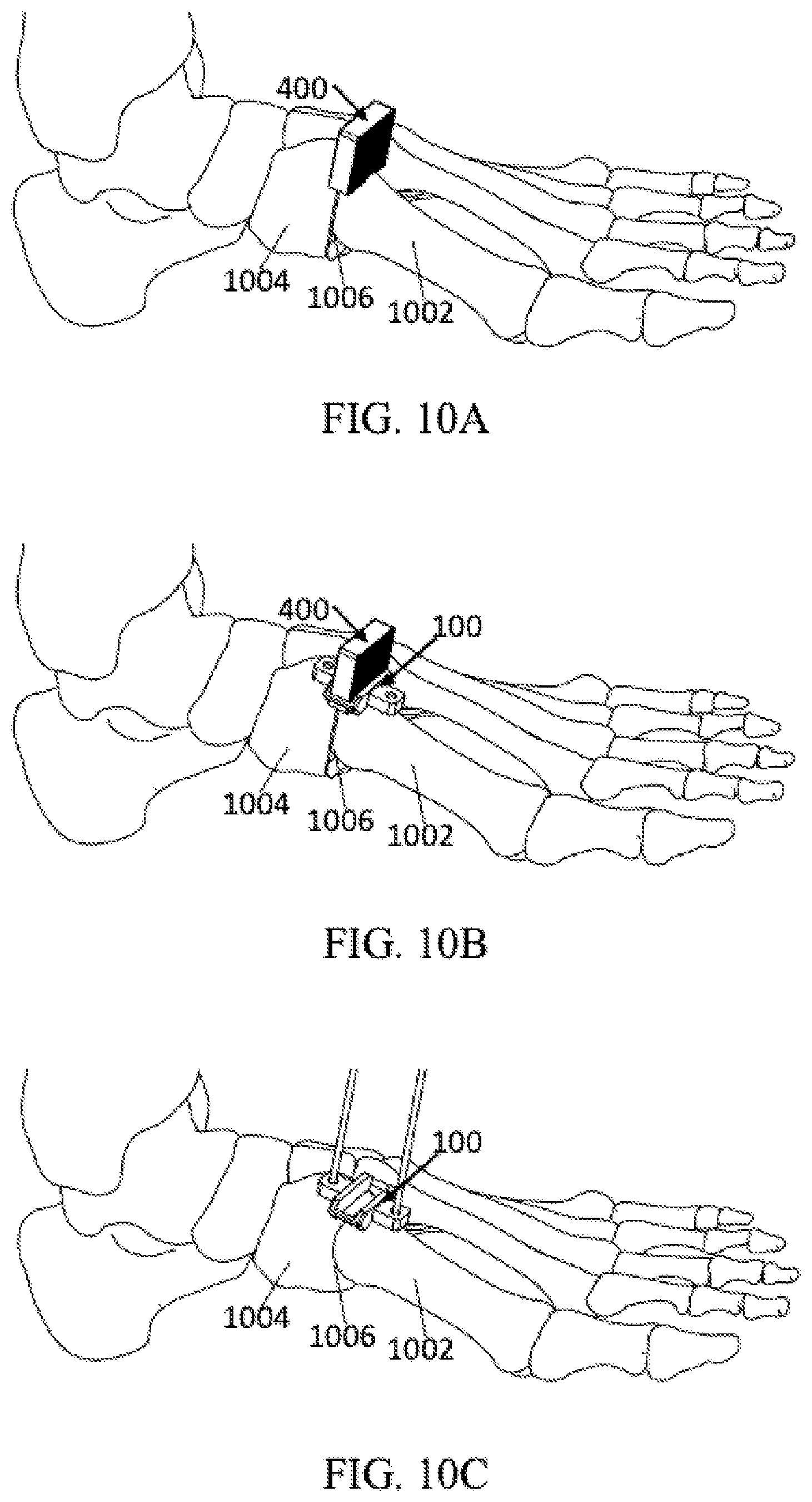 Patent US12303140 Figure 15 – Surgical systems and methods including cutting and aligning guides for performing an osteotomy