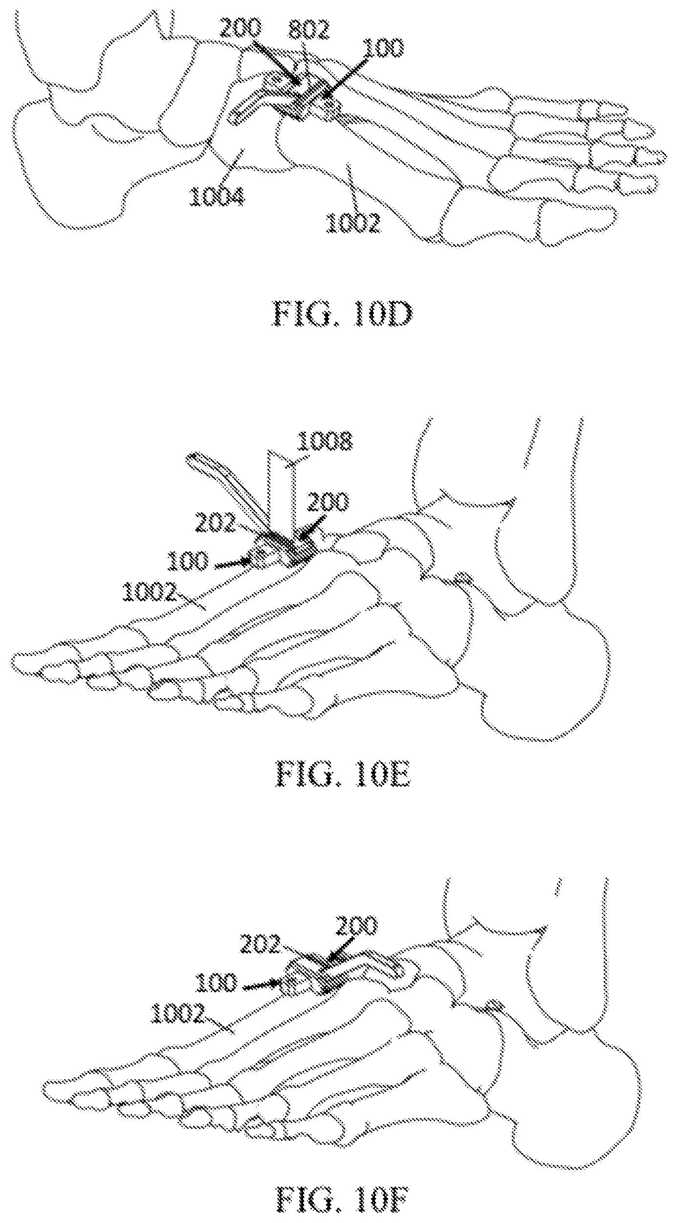 Patent US12303140 Figure 16 – Surgical systems and methods including cutting and aligning guides for performing an osteotomy