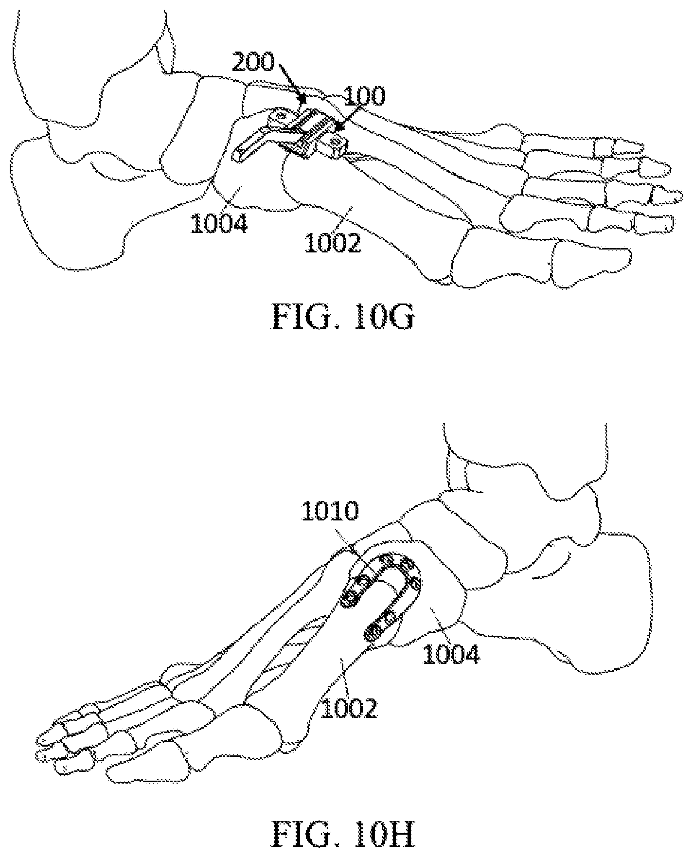Patent US12303140 Figure 17 – Surgical systems and methods including cutting and aligning guides for performing an osteotomy