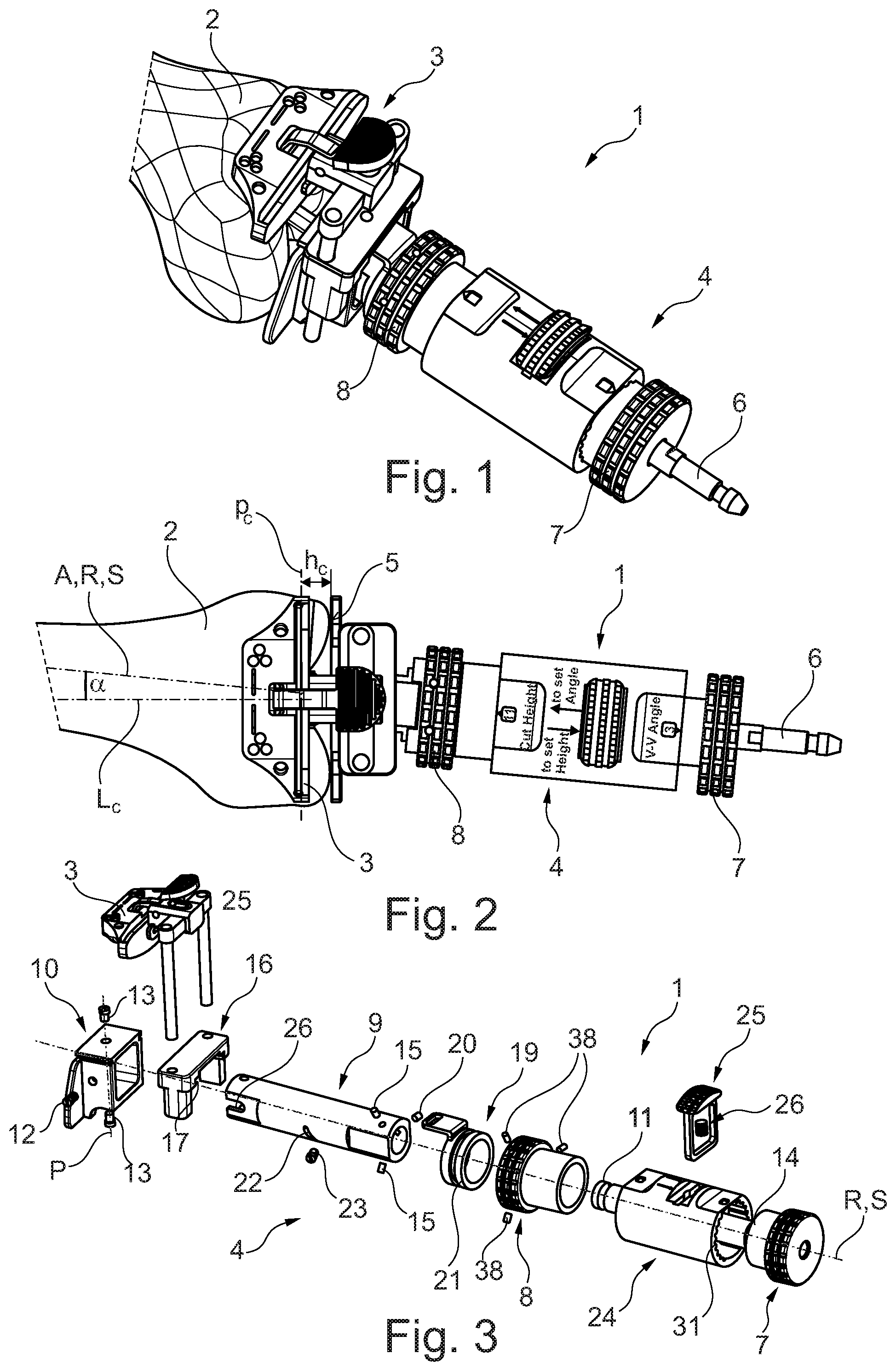 Patent US12303141 Figure 1 – Distal femur alignment system