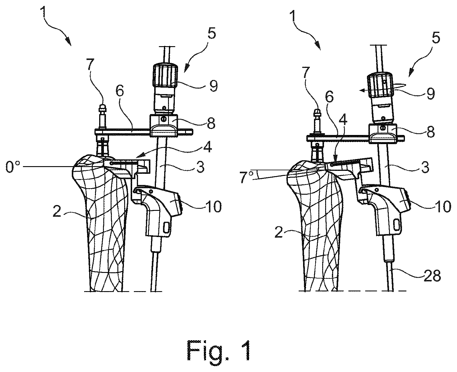Patent US12303142 Figure 1 – Intramedullary tibia alignment system