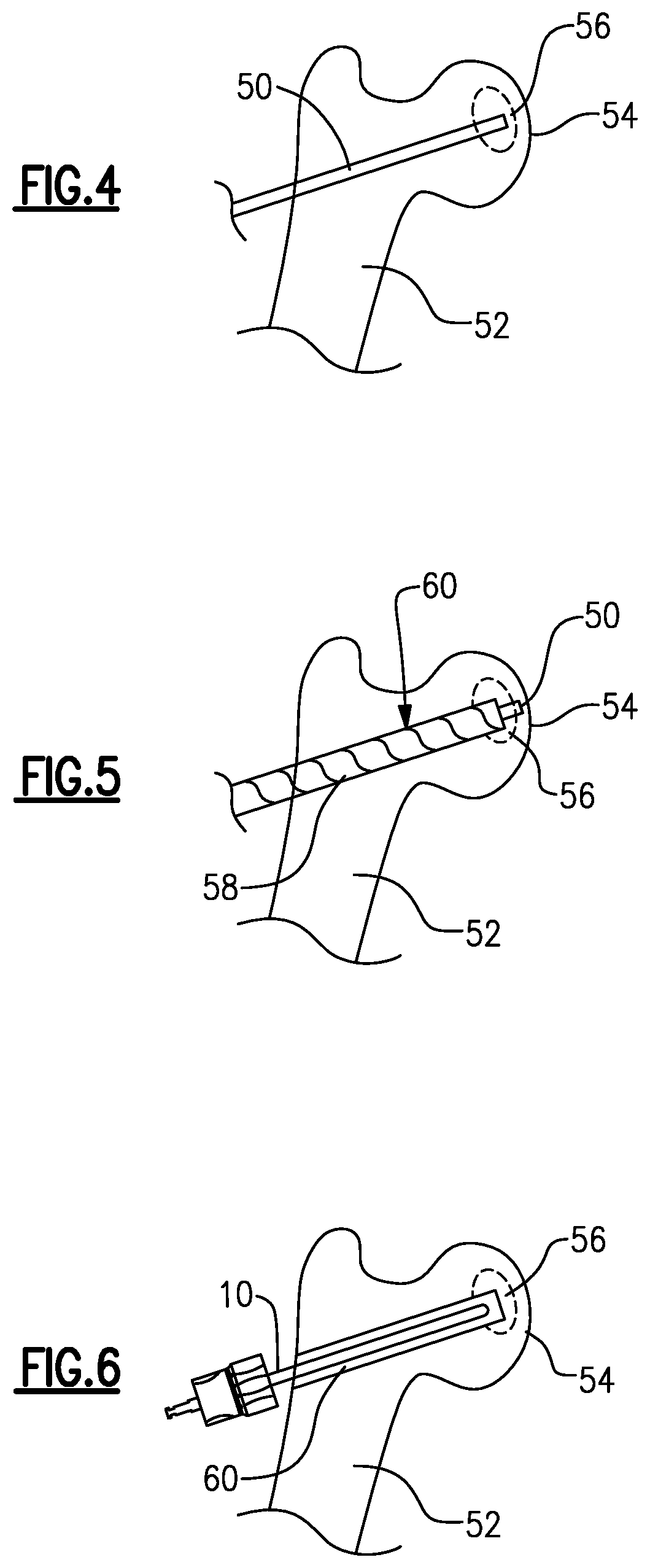 Patent US12303146 Figure 4 – Expandable reamer