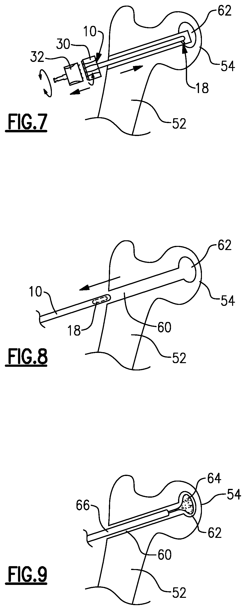 Patent US12303146 Figure 5 – Expandable reamer