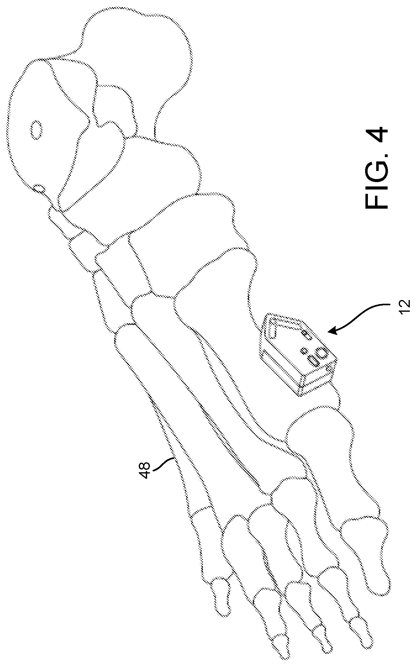 Patent US12303150 Figure 3 – Cut guide, systems, and methods