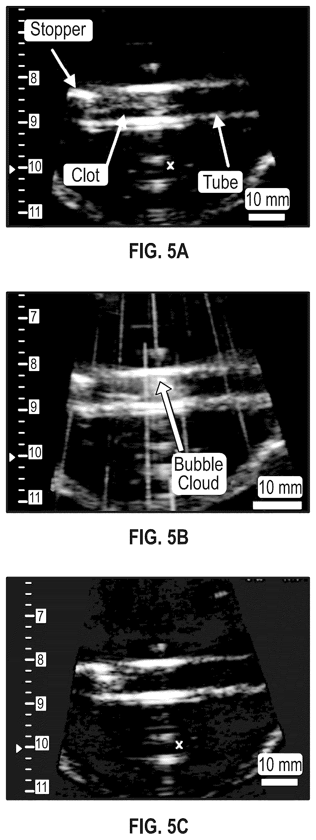 Patent US12303152 Figure 4 – Histotripsy for thrombolysis