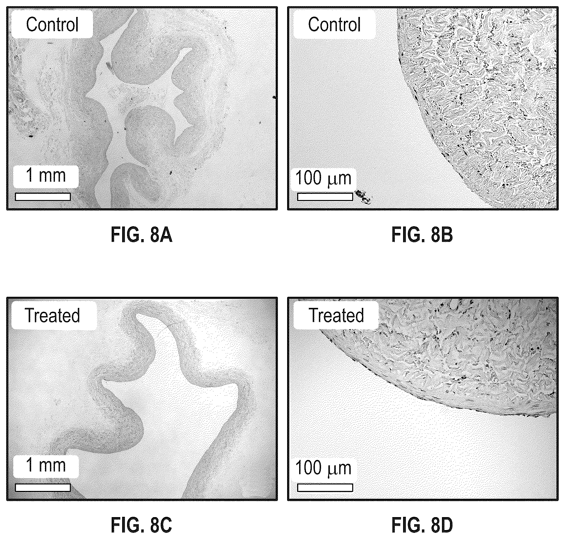 Patent US12303152 Figure 7 – Histotripsy for thrombolysis