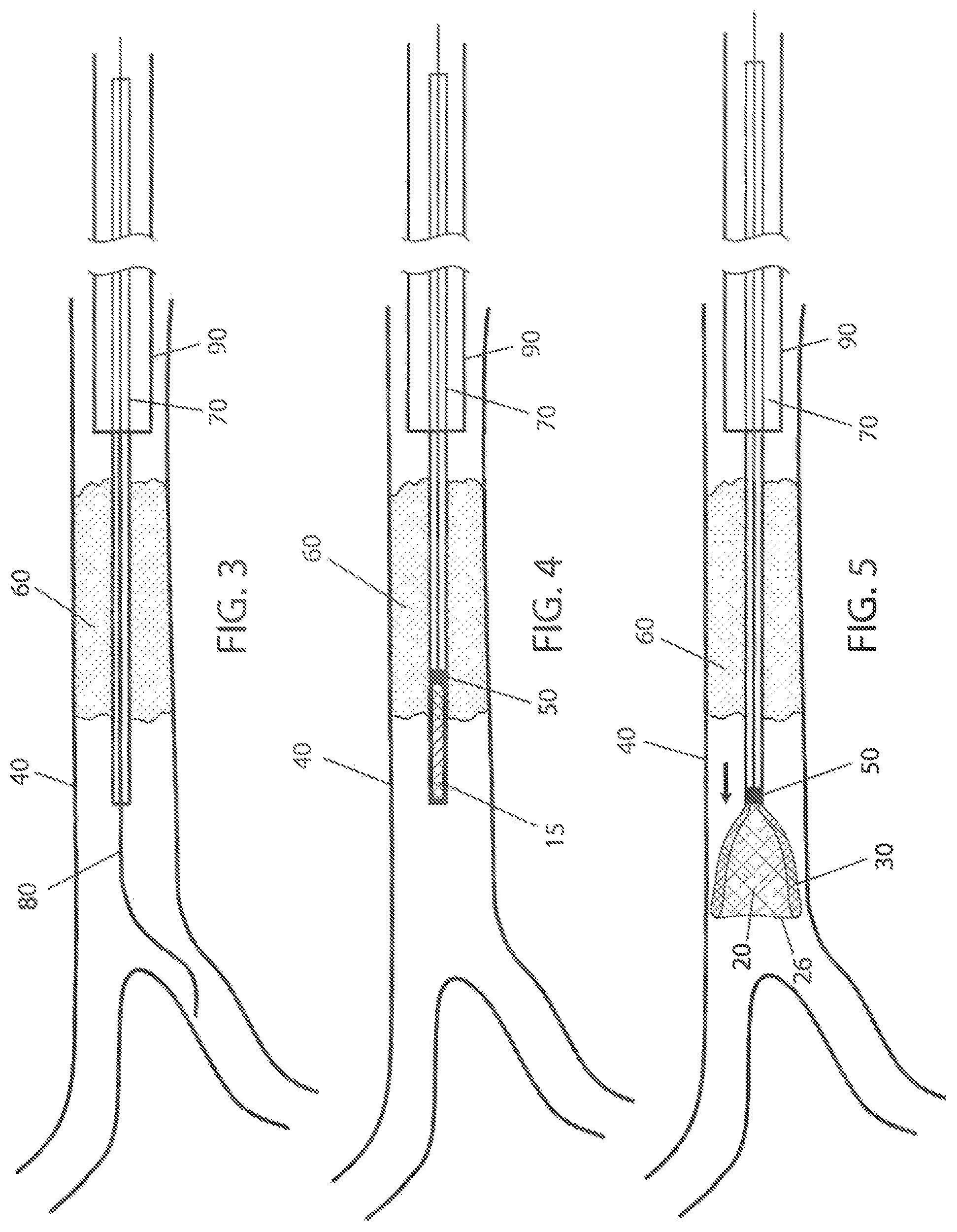 Patent US12303153 Figure 2 – Clot removal distal protection methods
