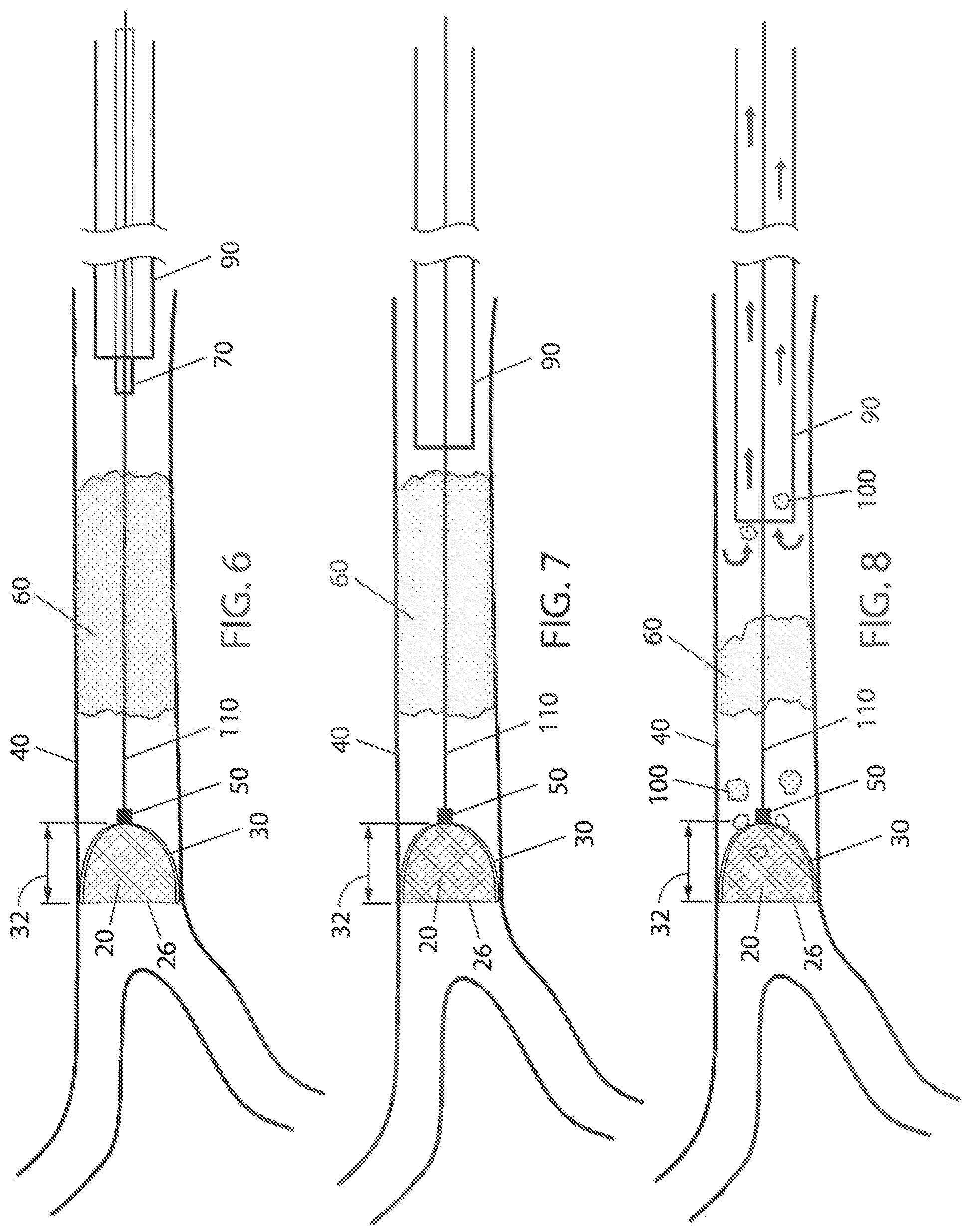 Patent US12303153 Figure 3 – Clot removal distal protection methods