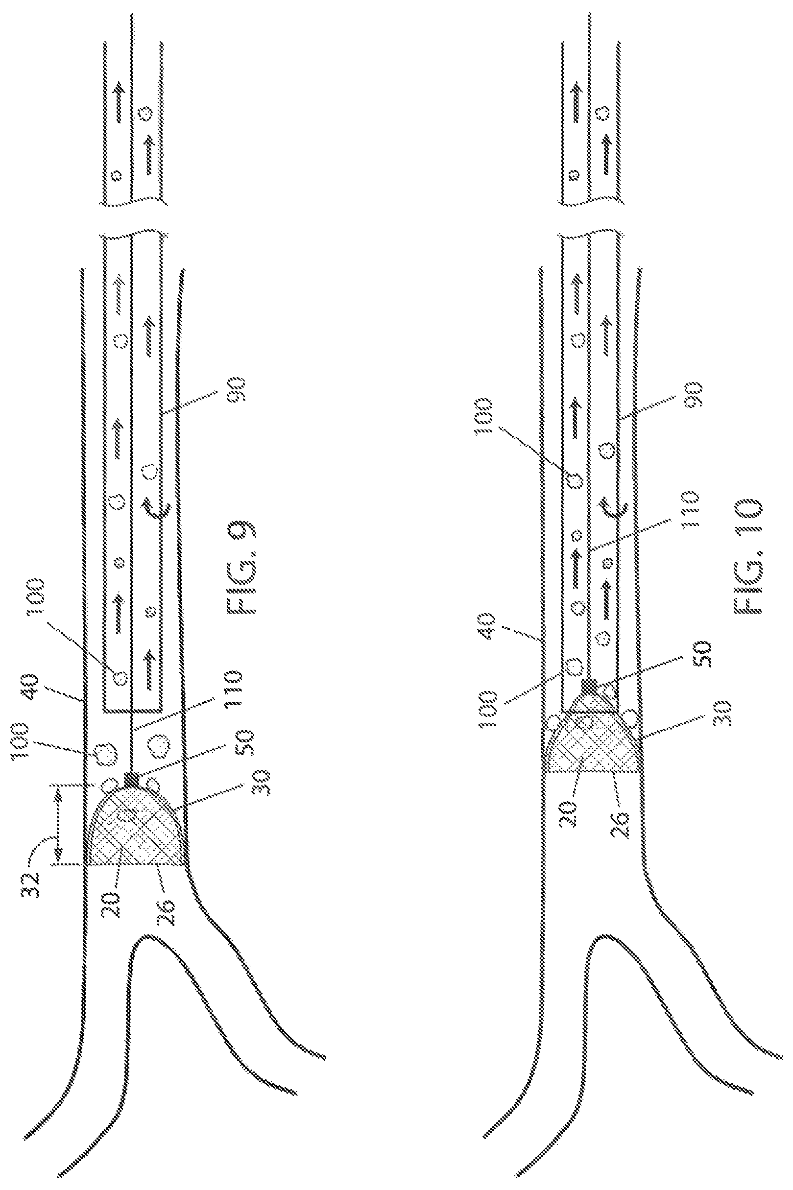 Patent US12303153 Figure 4 – Clot removal distal protection methods