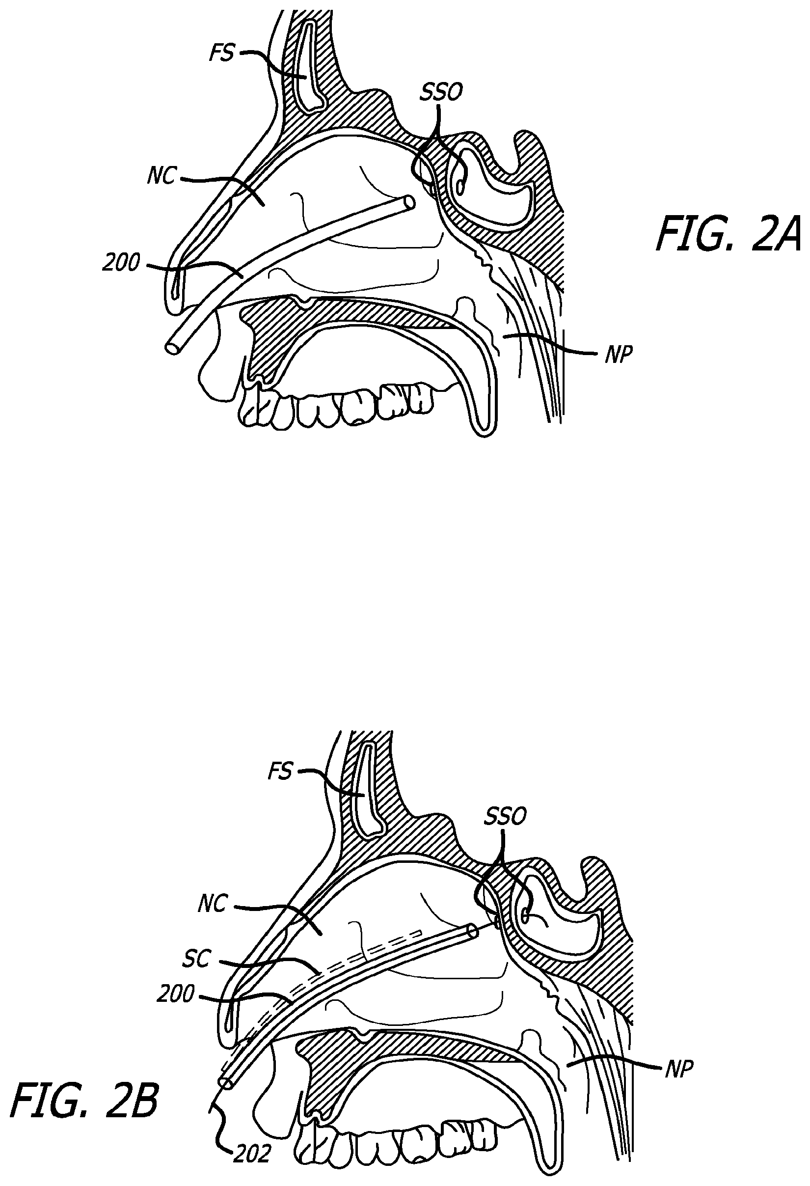 Patent US12303154 Figure 3 – Guide system with suction