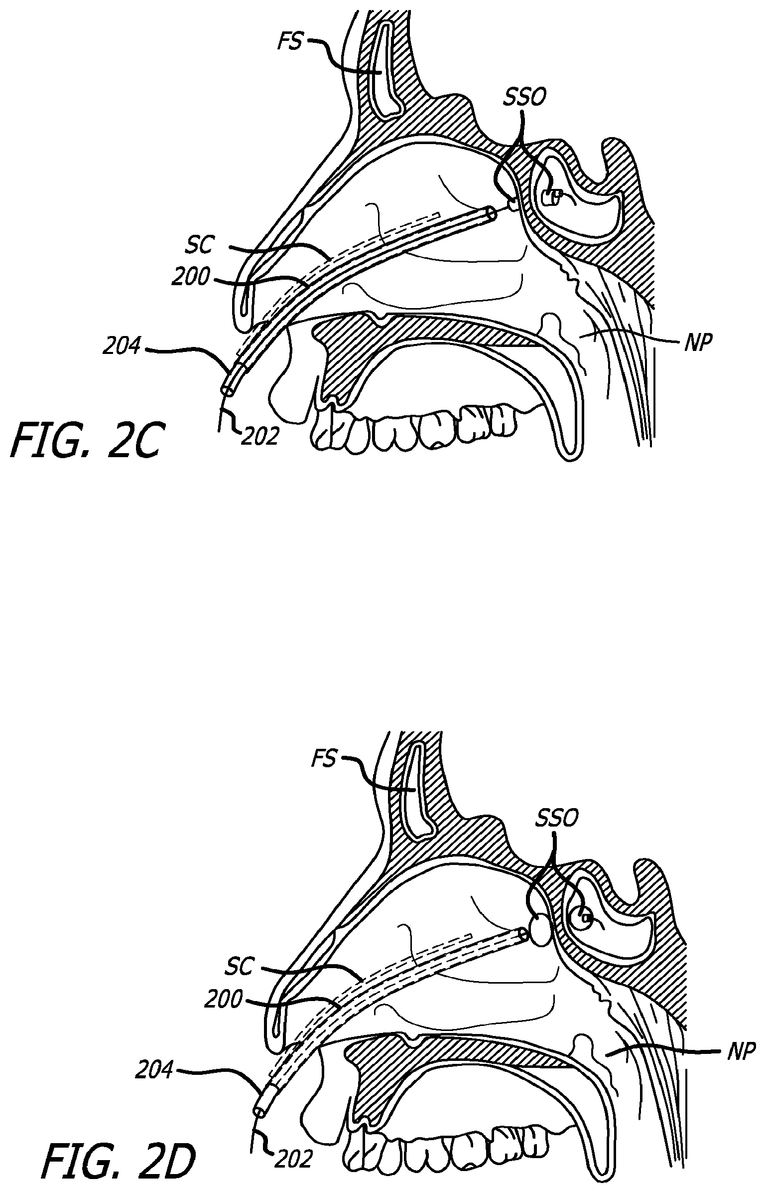 Patent US12303154 Figure 4 – Guide system with suction