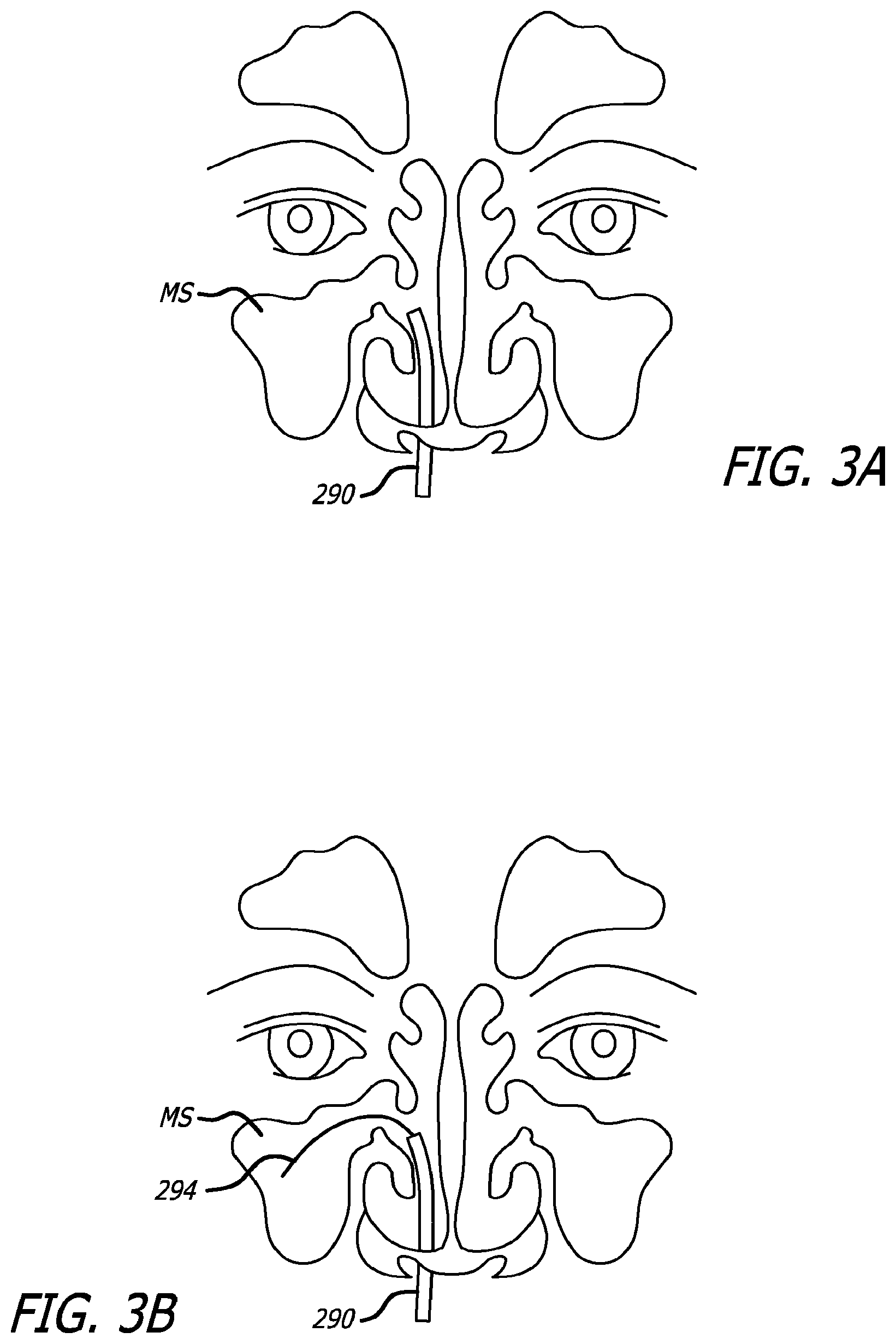 Patent US12303154 Figure 5 – Guide system with suction