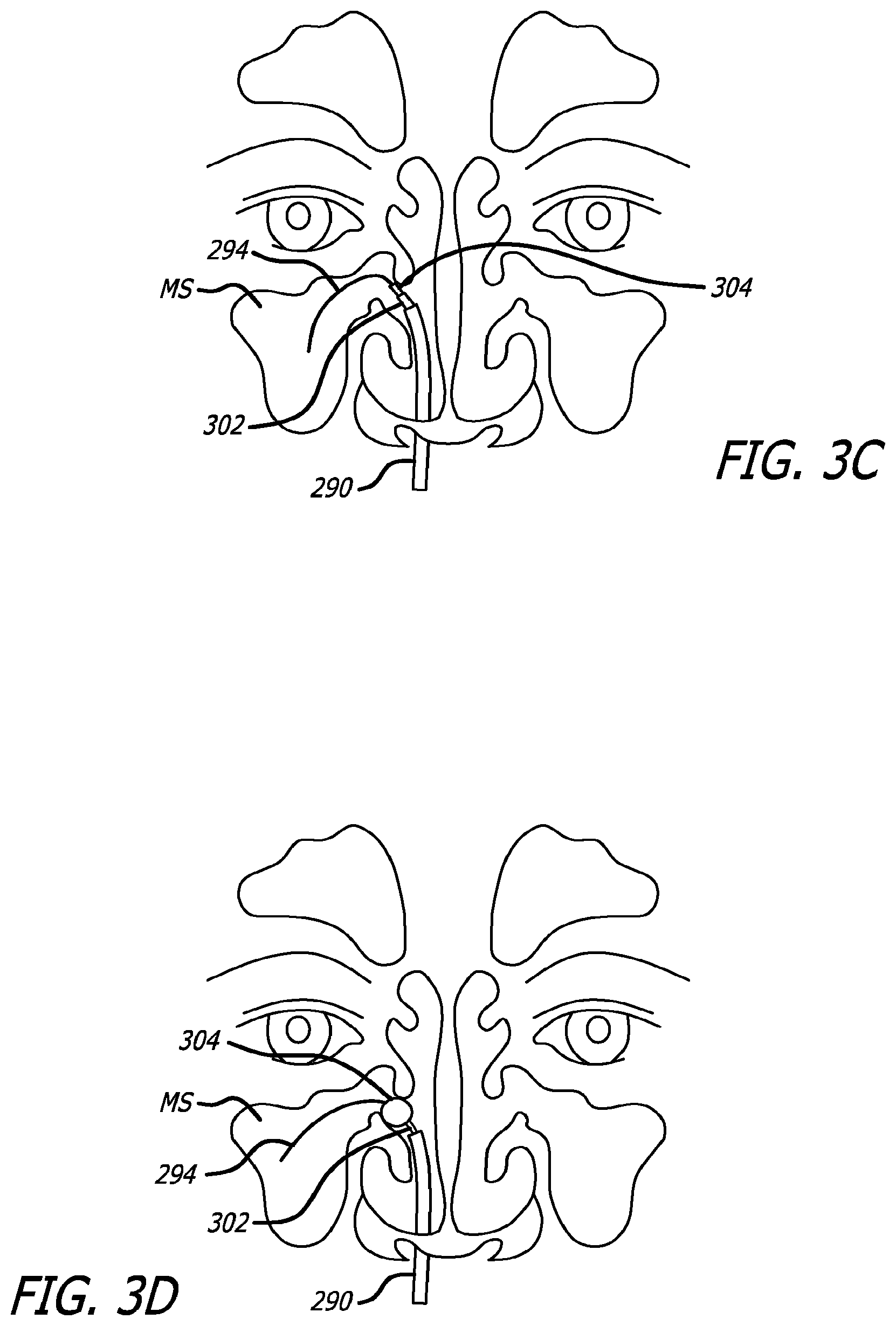 Patent US12303154 Figure 6 – Guide system with suction