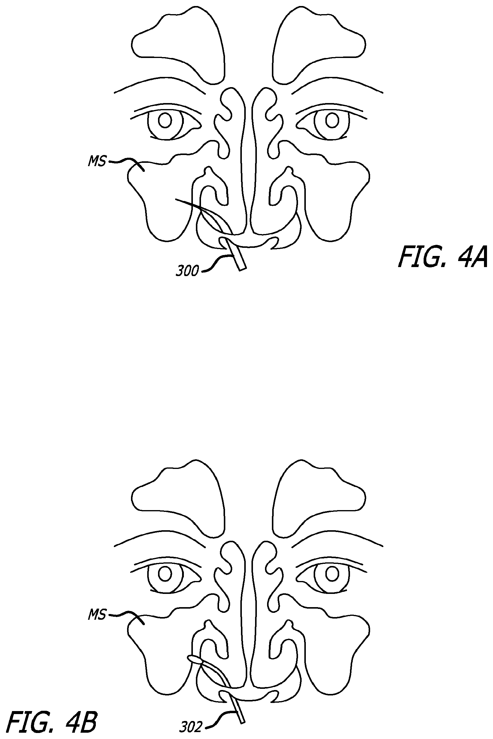 Patent US12303154 Figure 7 – Guide system with suction