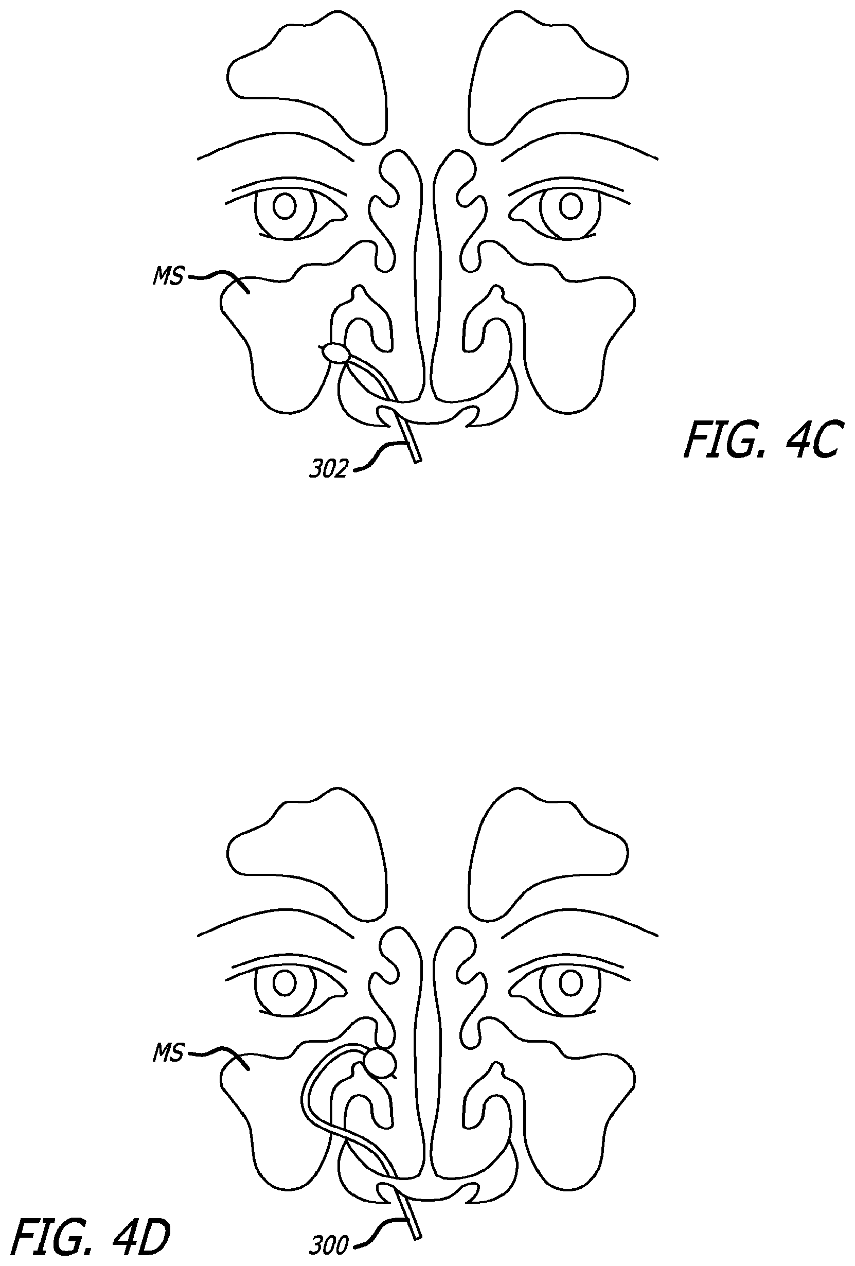 Patent US12303154 Figure 8 – Guide system with suction