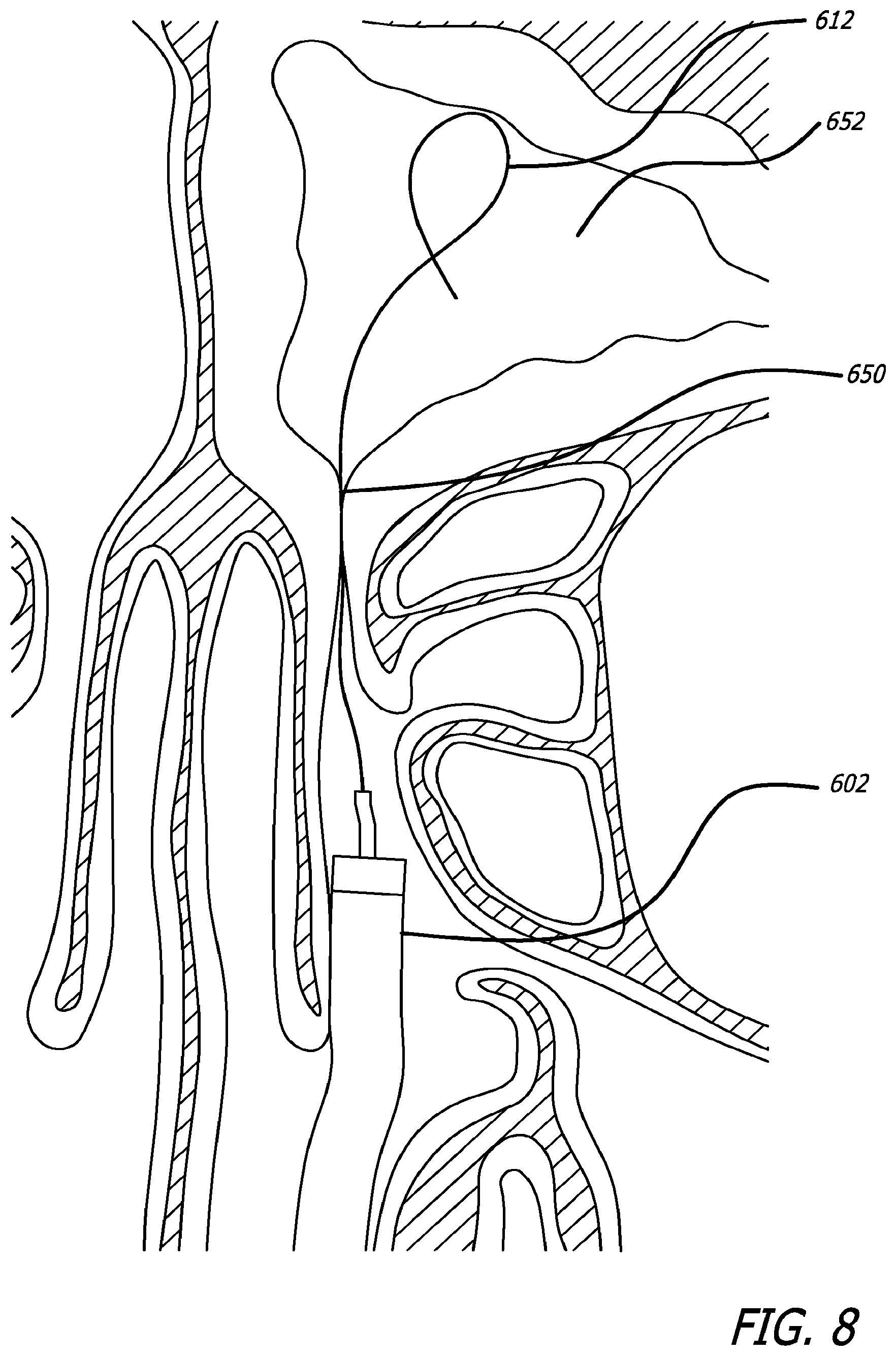 Patent US12303154 Figure 11 – Guide system with suction