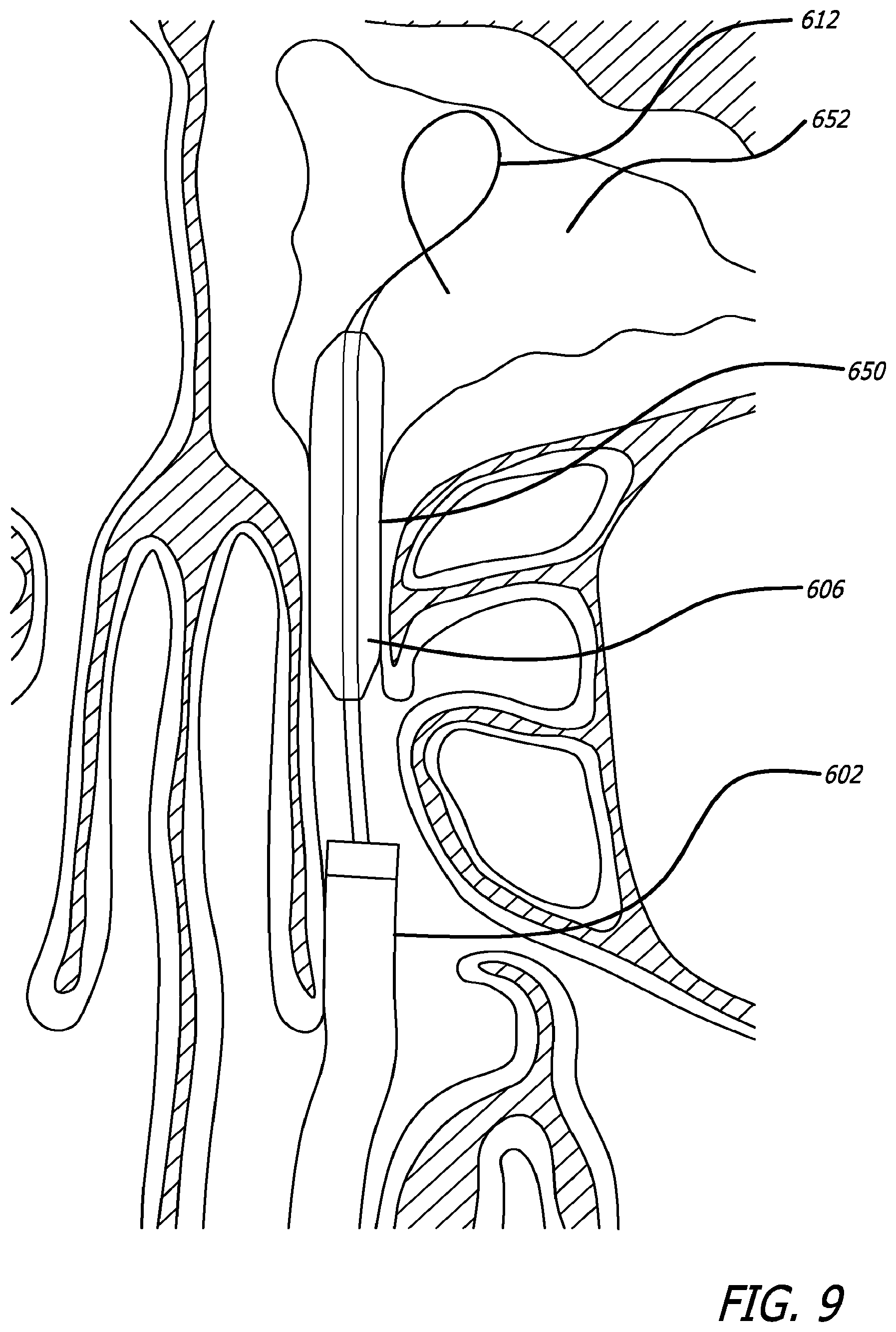 Patent US12303154 Figure 12 – Guide system with suction
