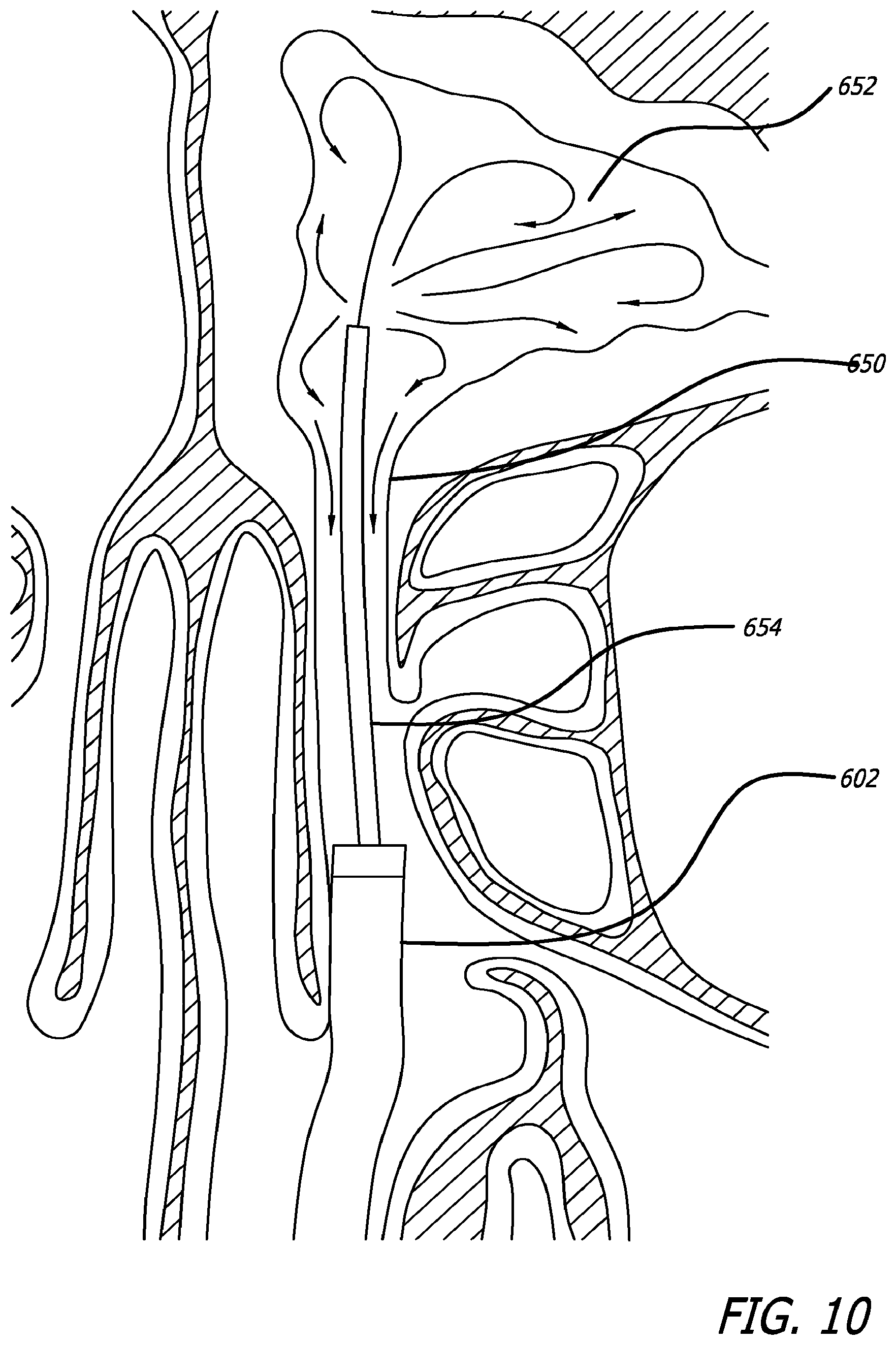 Patent US12303154 Figure 13 – Guide system with suction