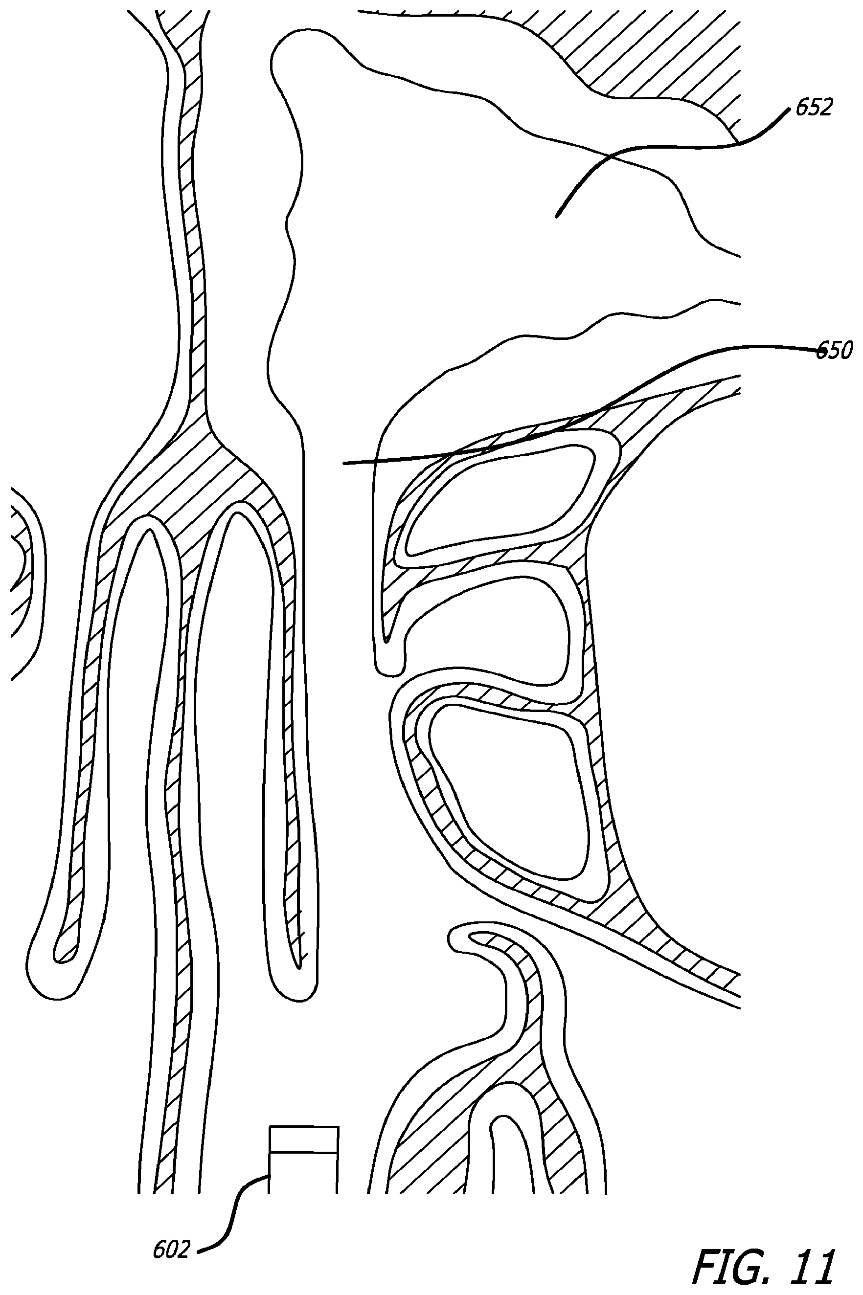 Patent US12303154 Figure 14 – Guide system with suction