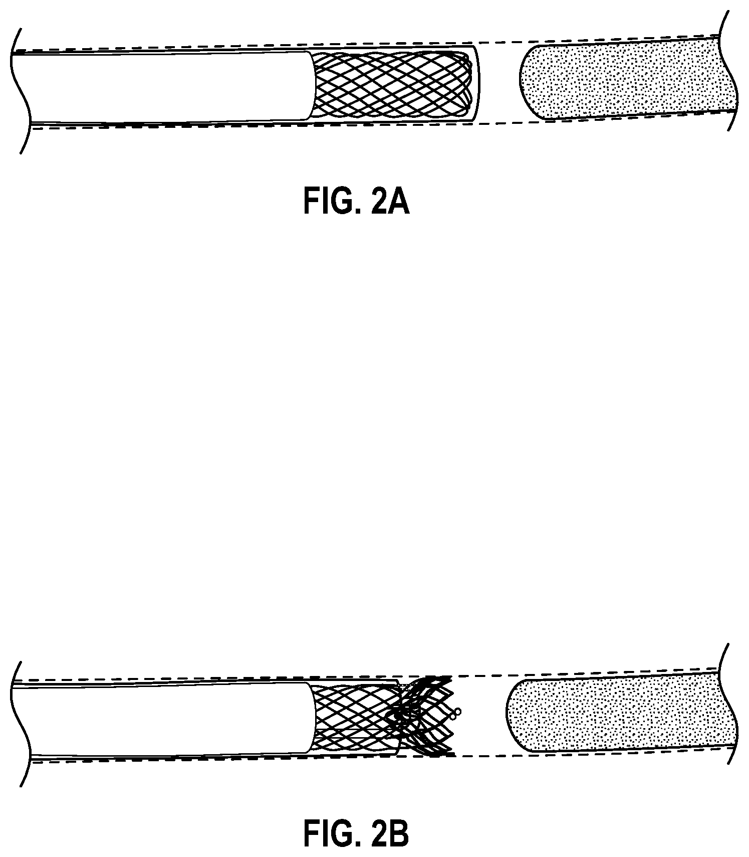 Patent US12303160 Figure 2 – Deployable dynamic stent and adjustable cutting jet device
