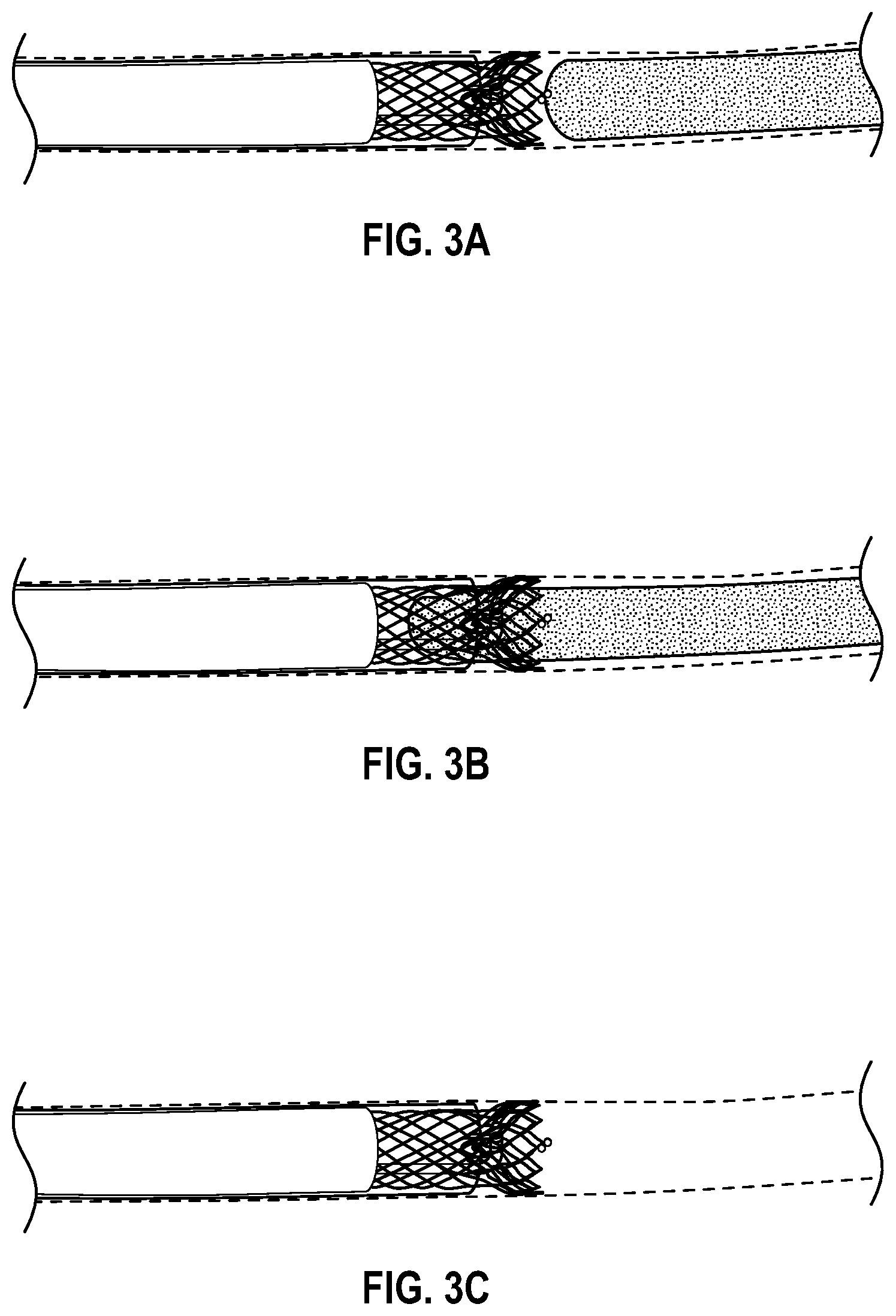 Patent US12303160 Figure 3 – Deployable dynamic stent and adjustable cutting jet device