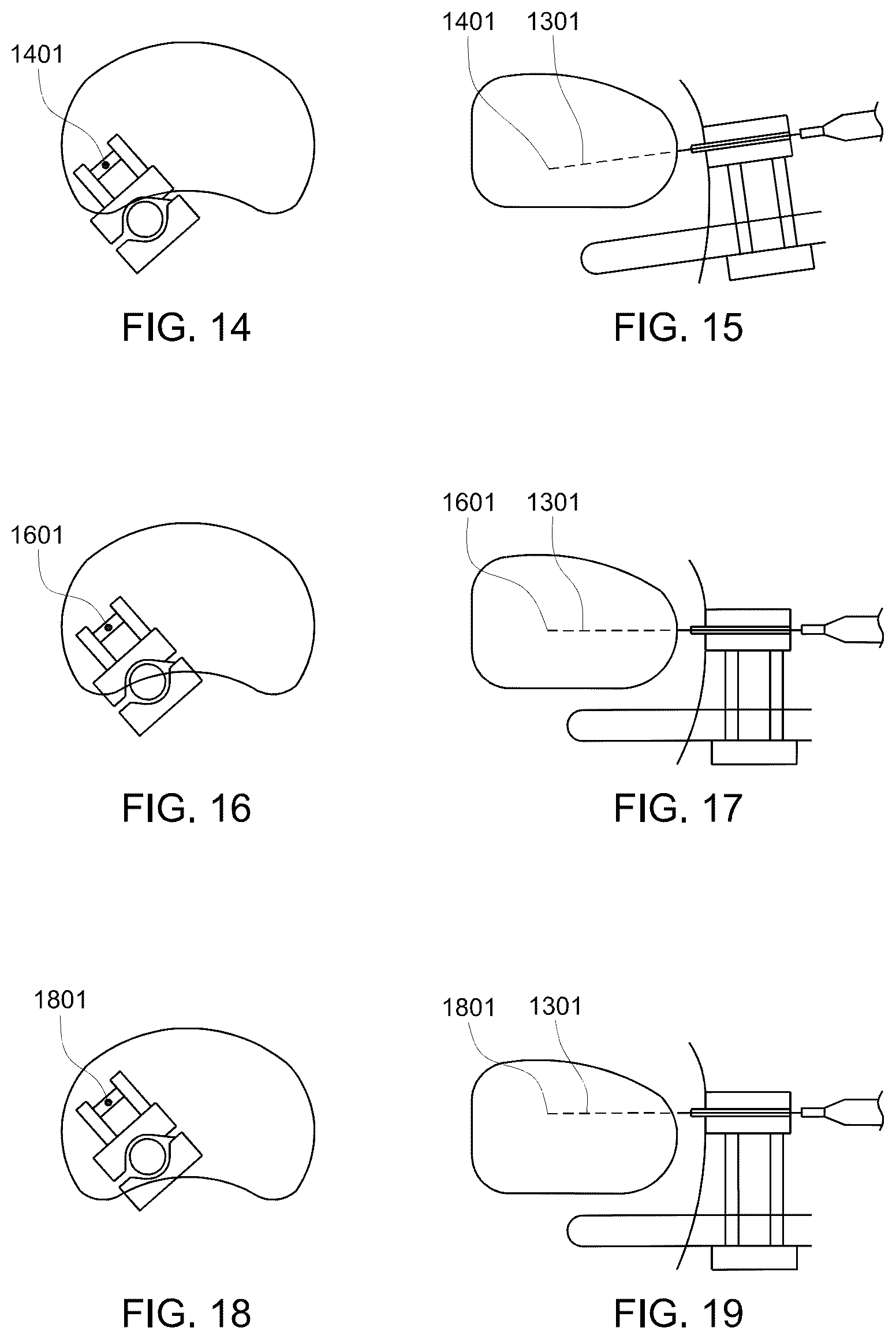 Patent US12303164 Figure 6 – Transperineal biopsy guide with mount, guide member, and displacement member displaceable within a gap of the guide member