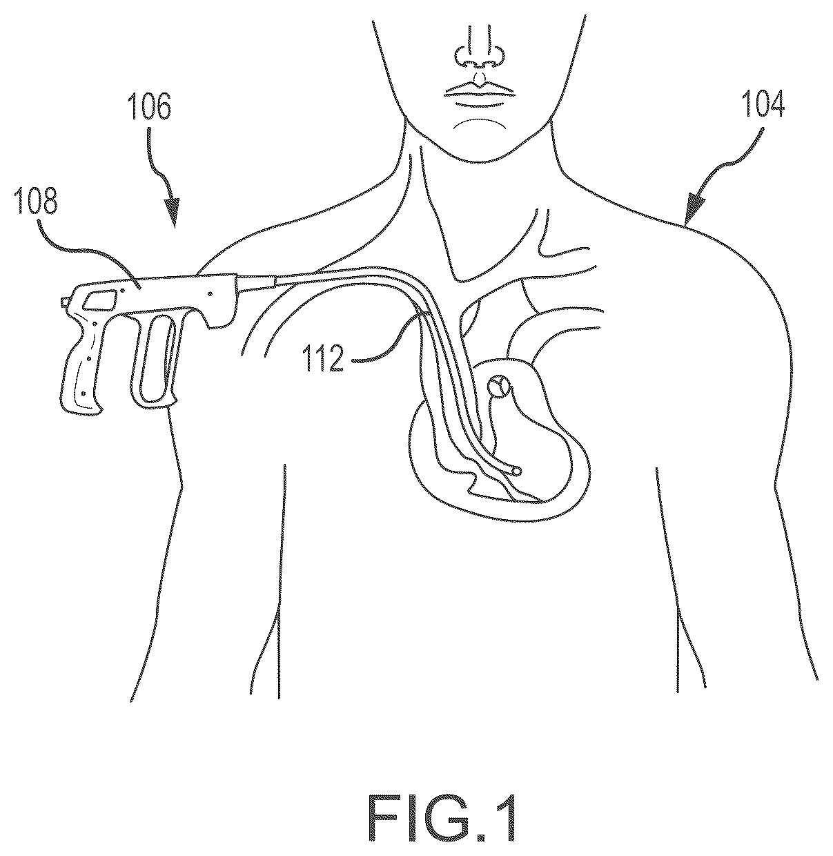 Patent US12303165 Figure 1 – Medical device for removing an implanted object using laser cut hypotubes