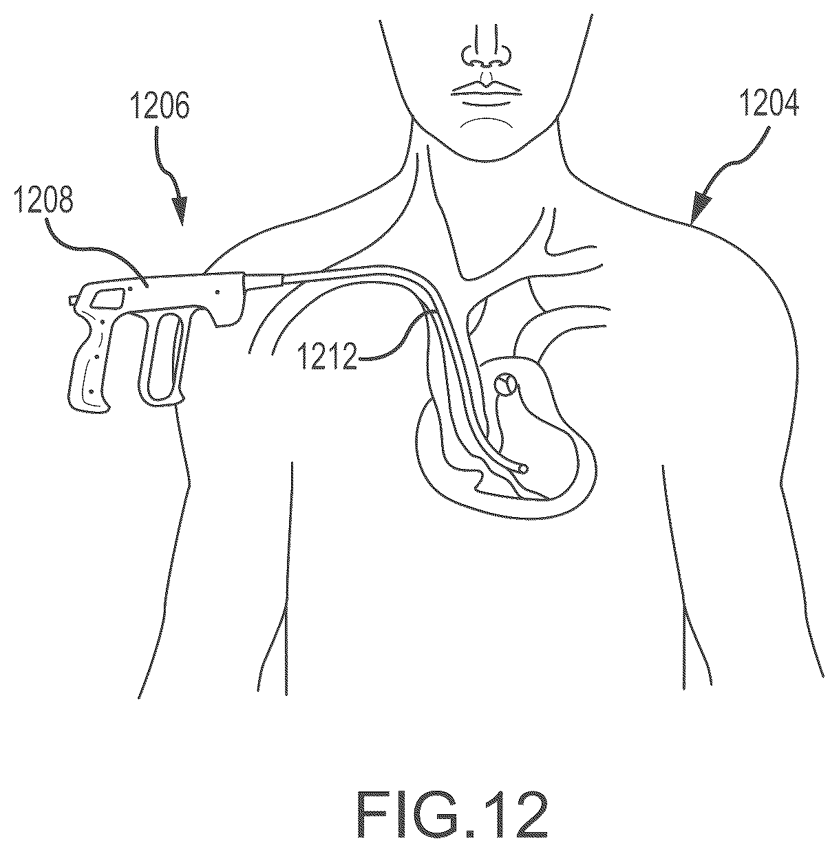 Patent US12303165 Figure 14 – Medical device for removing an implanted object using laser cut hypotubes
