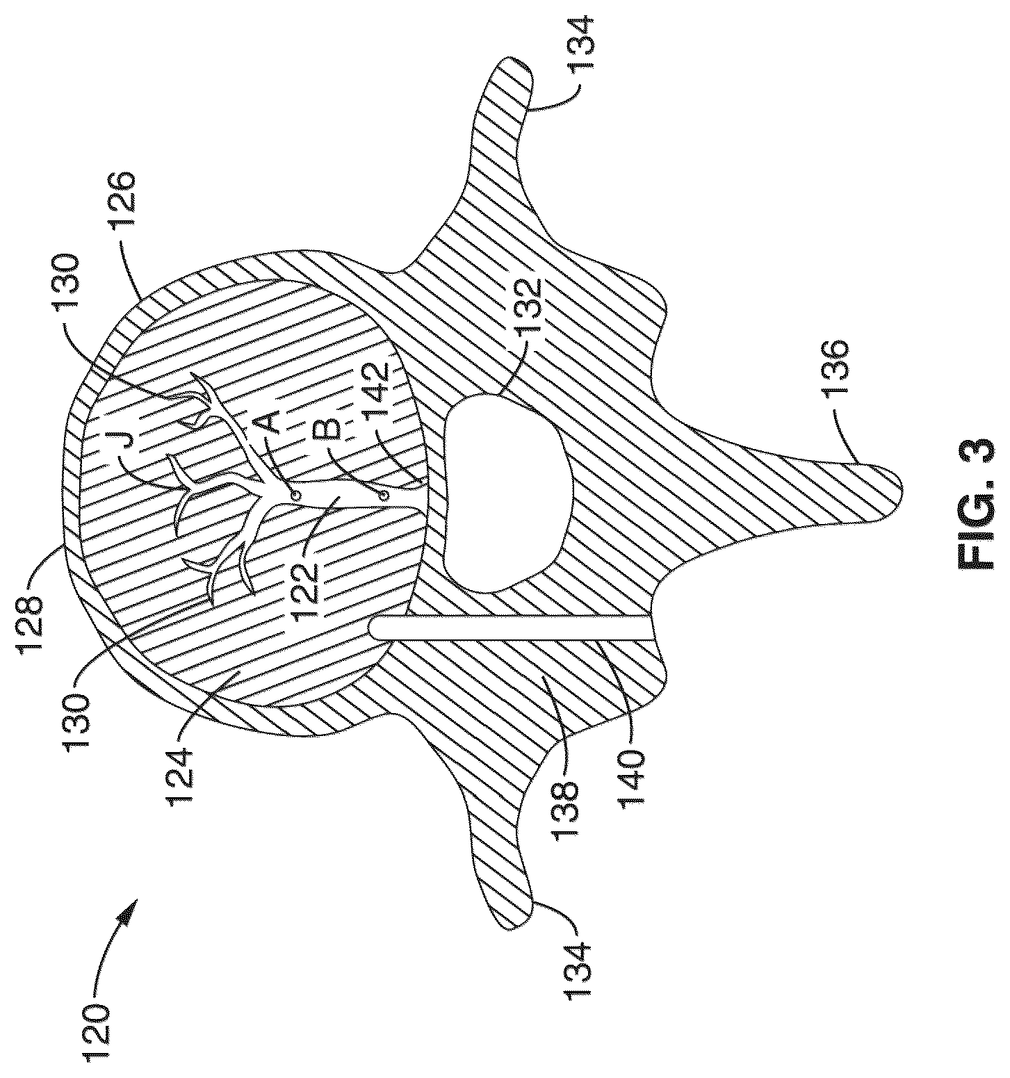 Patent US12303166 Figure 3 – Methods for accessing nerves within bone