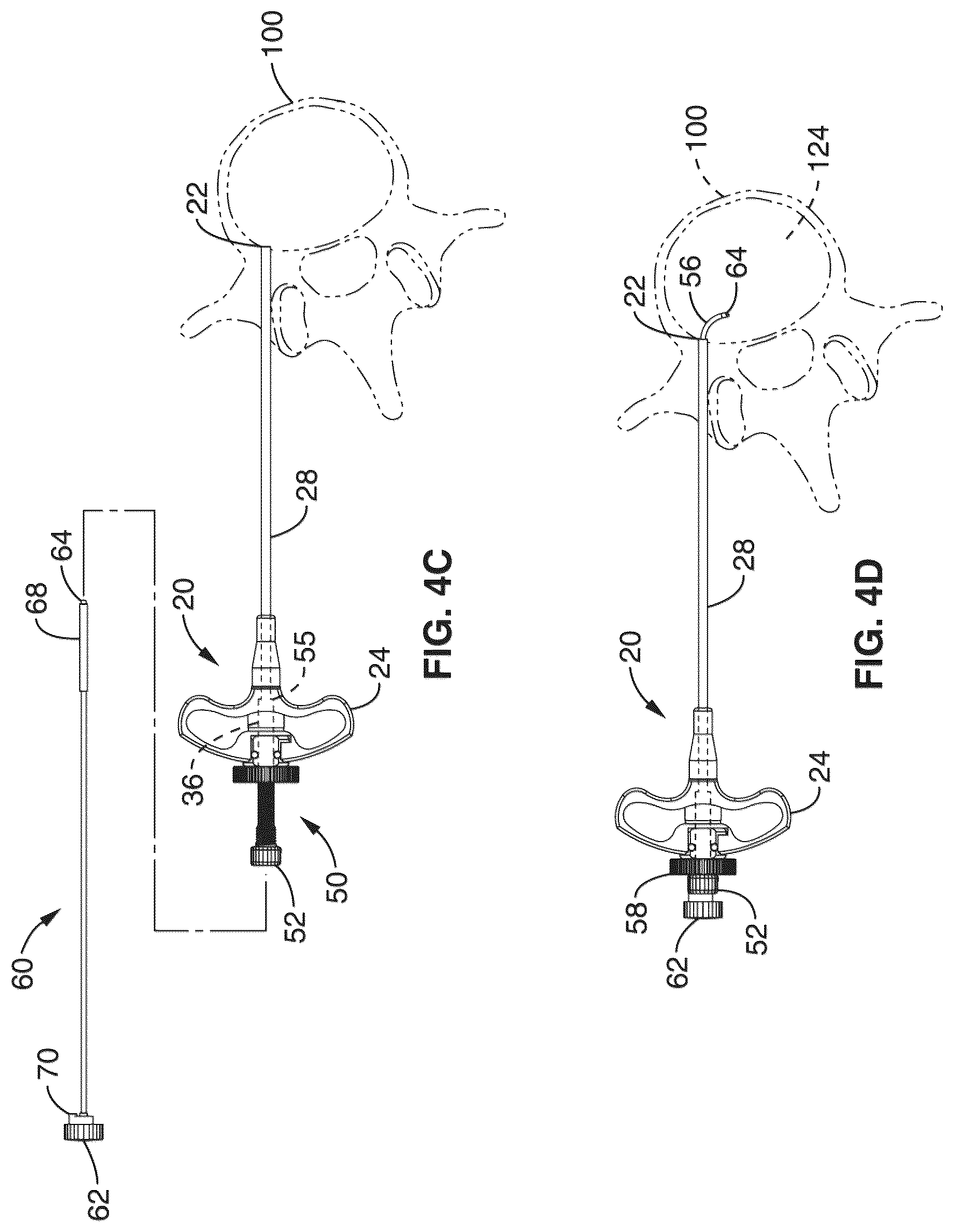 Patent US12303166 Figure 5 – Methods for accessing nerves within bone