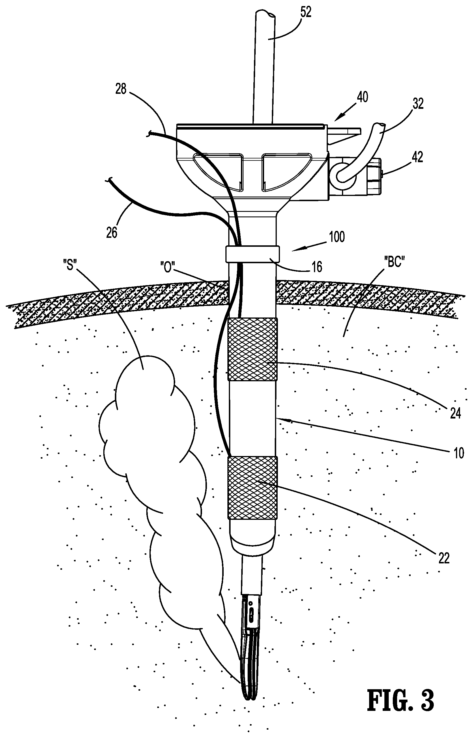 Patent US12303167 Figure 3 – Surgical access device with active smoke filtration
