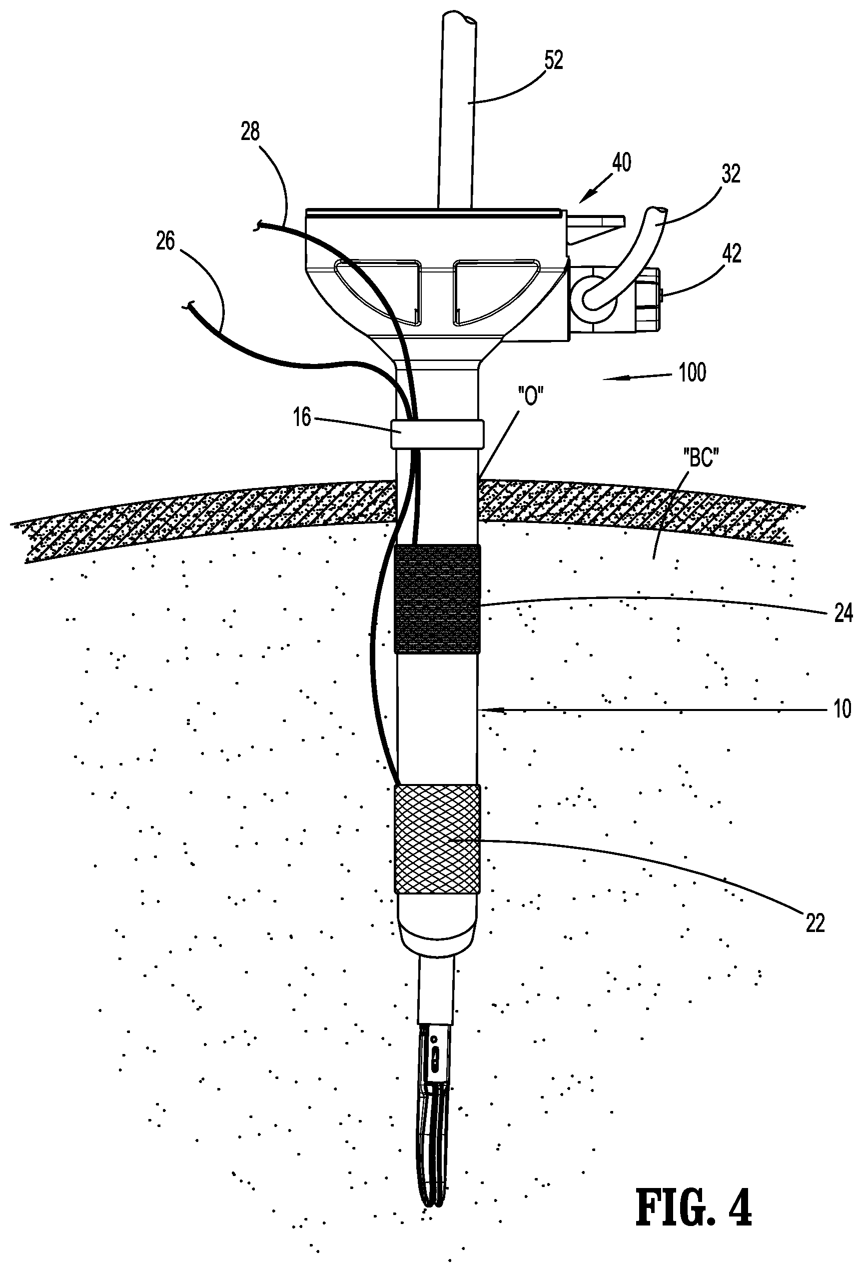 Patent US12303167 Figure 4 – Surgical access device with active smoke filtration