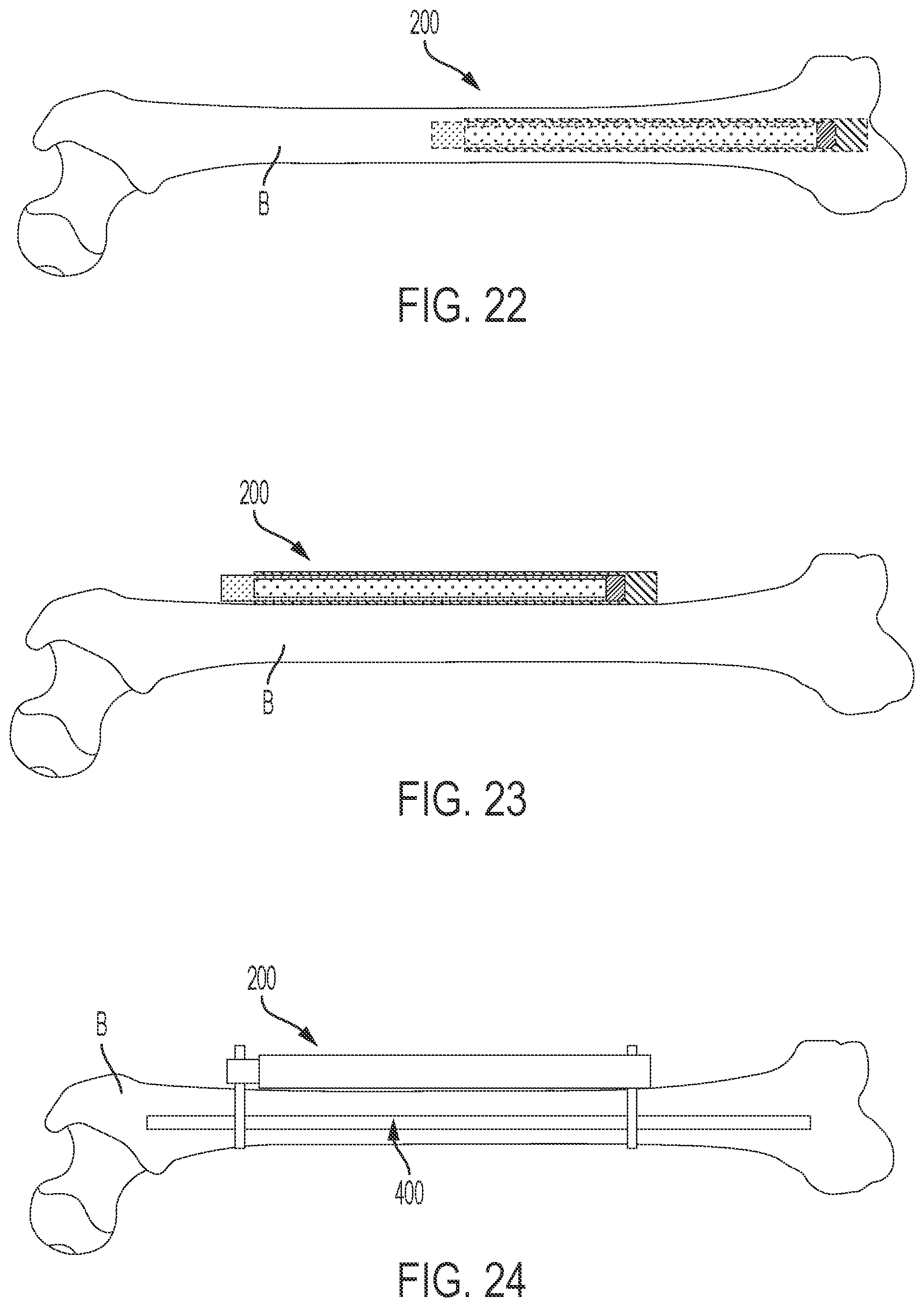 Patent US12303169 Figure 12 – Bone elongating devices and methods of use
